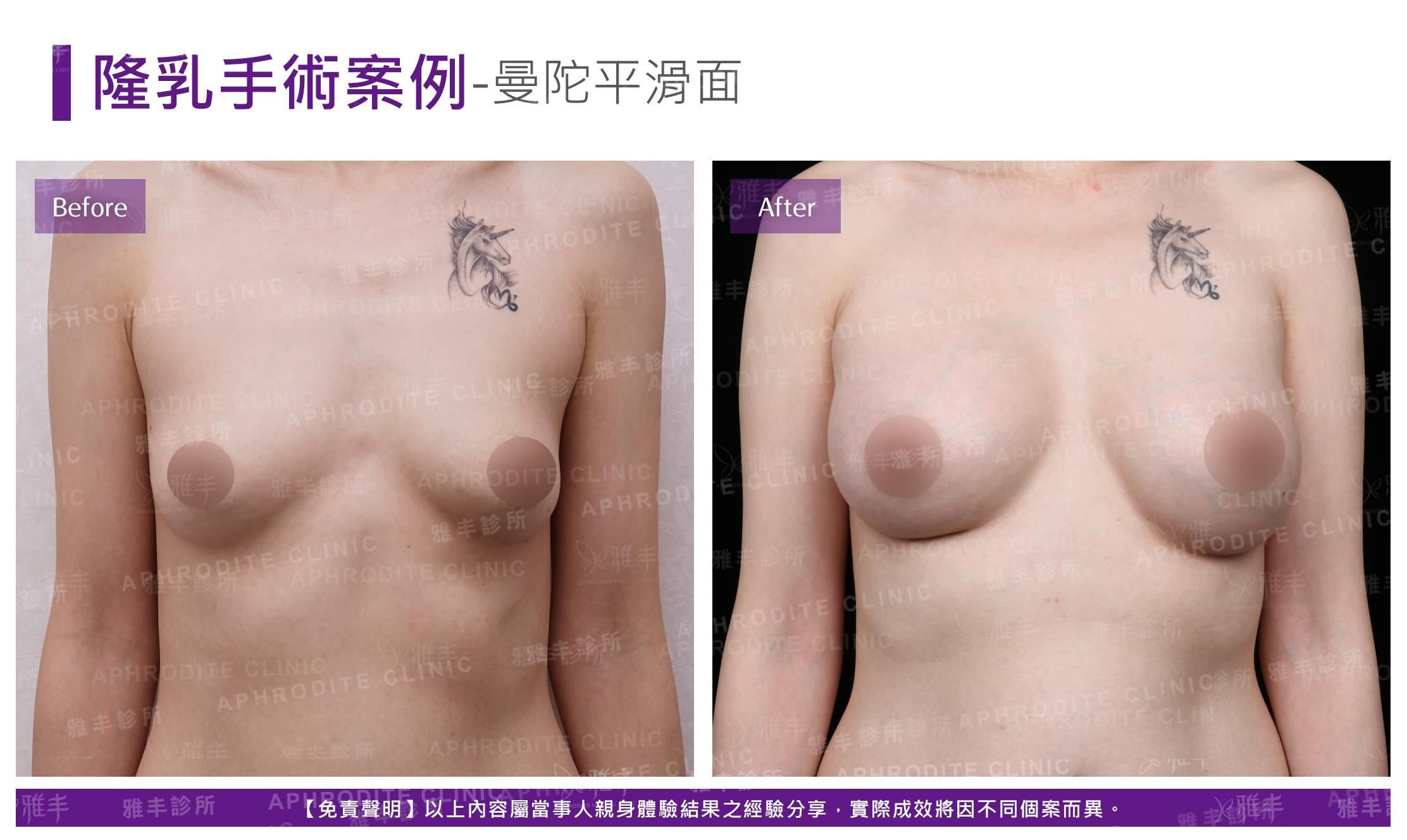 隆乳手術-case26-F