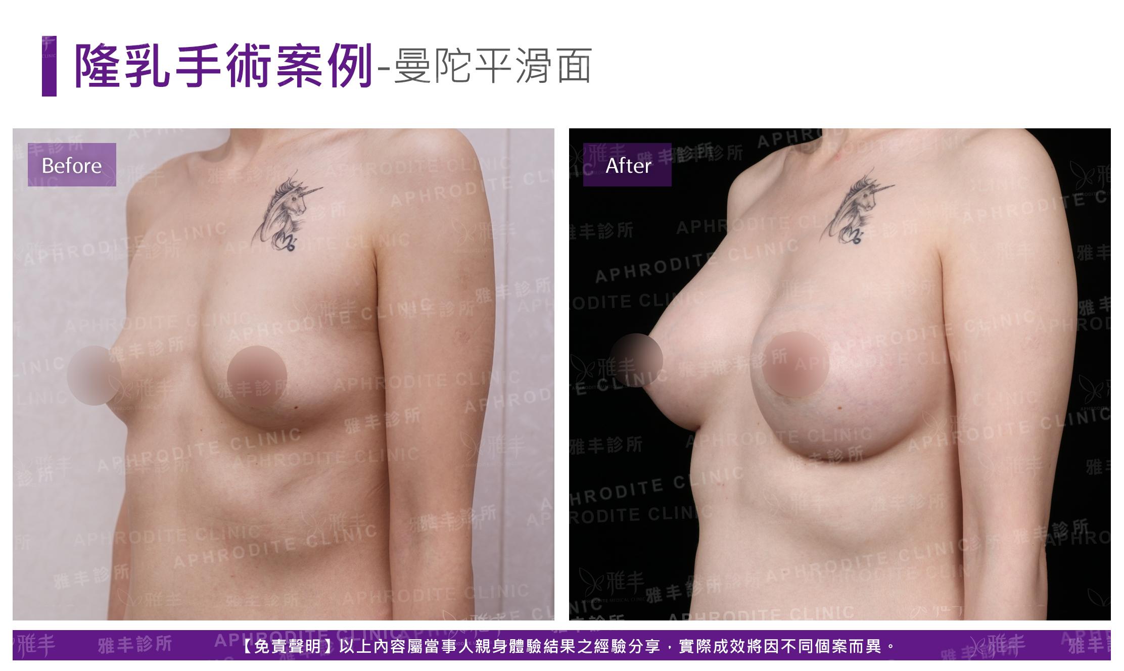 隆乳手術-case26-L45.jpg