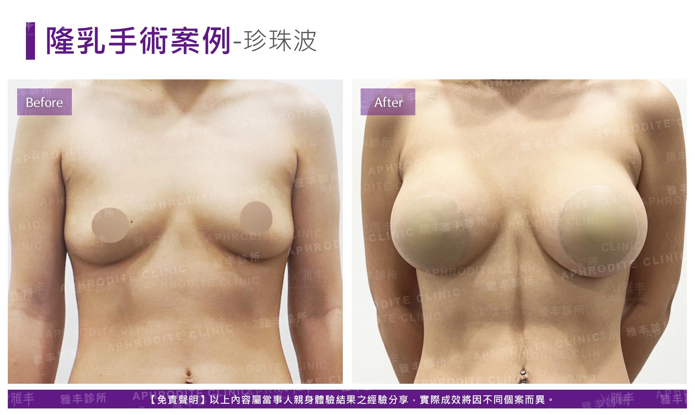隆乳手術-case27-F.jpg