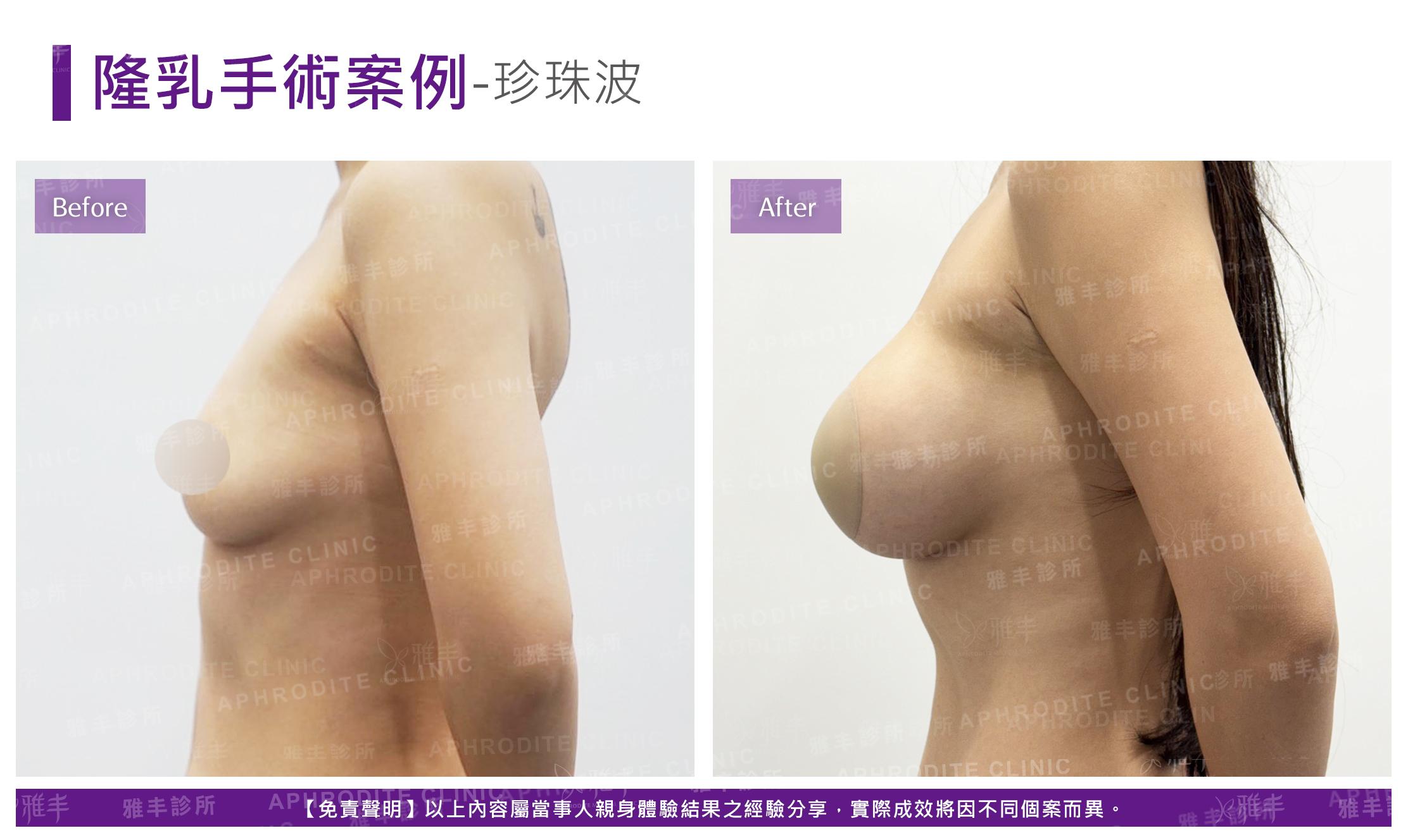 隆乳手術-case27-L90.jpg