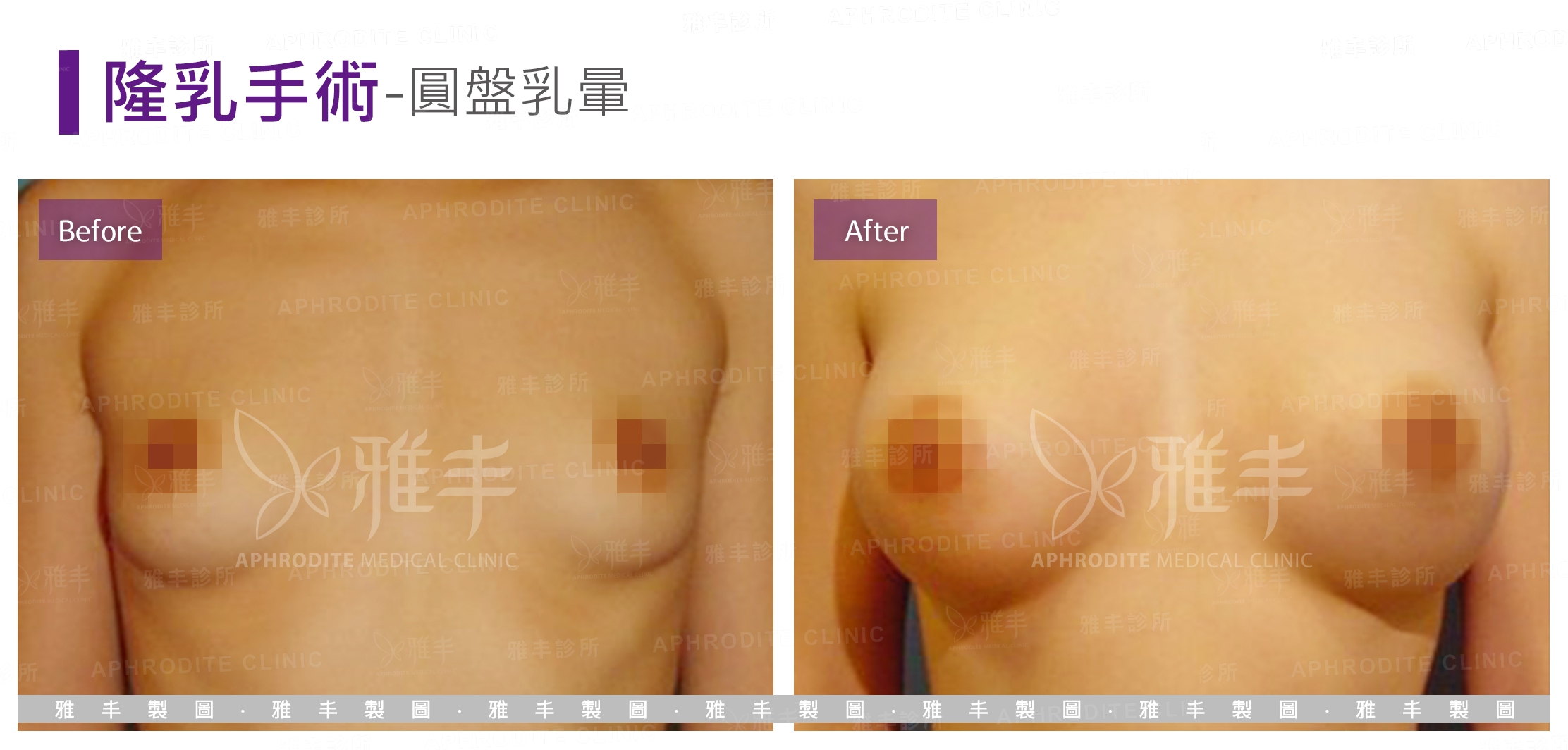隆乳手術-圓盤乳暈(Case3)