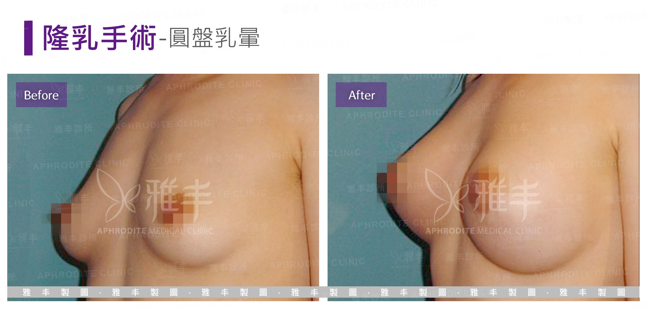 隆乳手術-圓盤乳暈(Case3-L45)