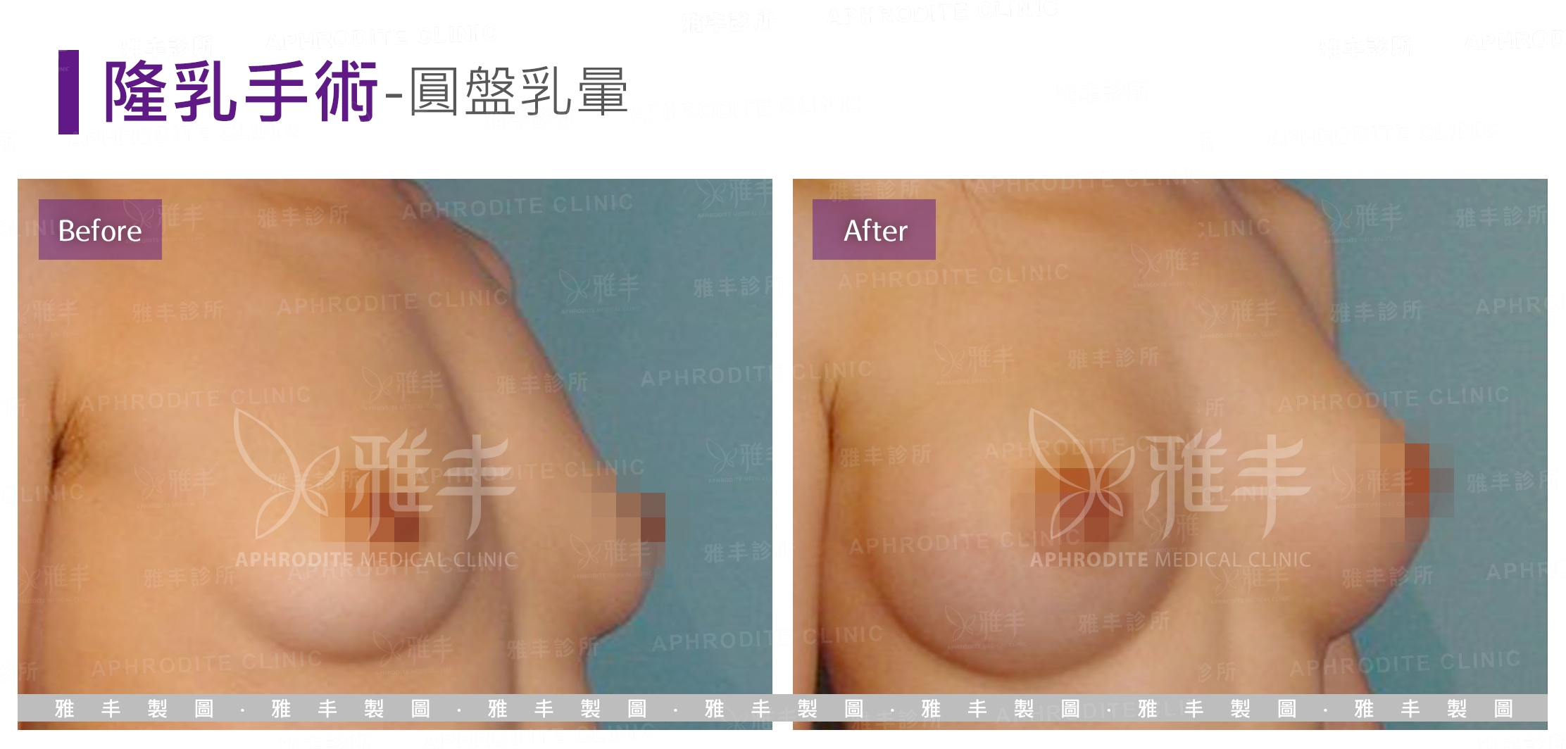 隆乳手術-圓盤乳暈(Case3-R45)