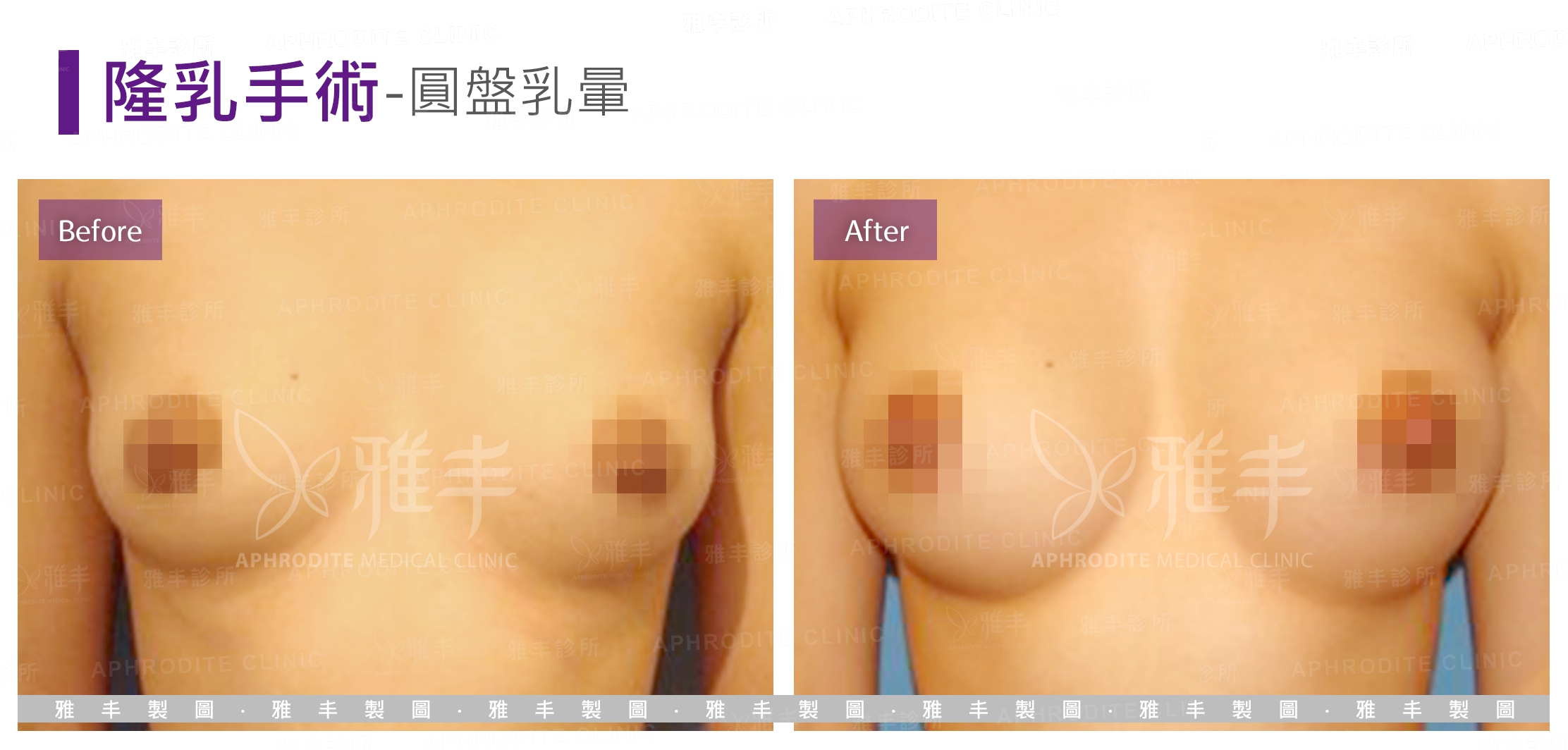 隆乳手術-圓盤乳暈(Case4)