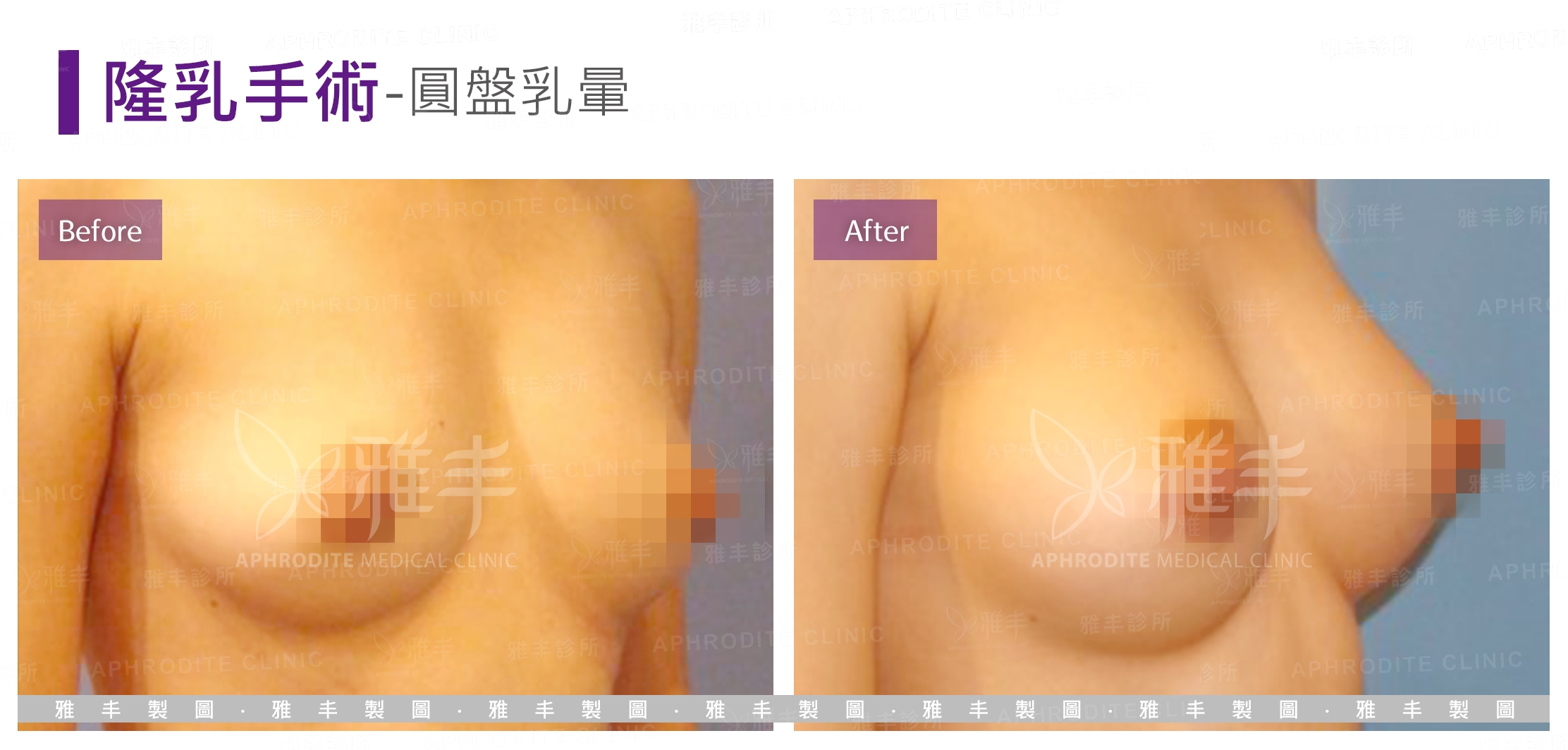 隆乳手術-圓盤乳暈(Case4-R45)