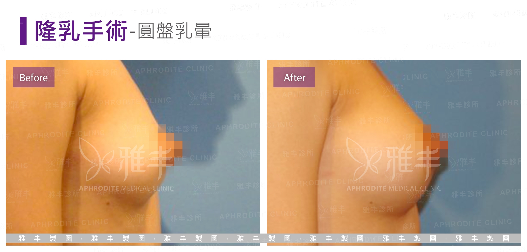 隆乳手術-圓盤乳暈(Case4-R90)