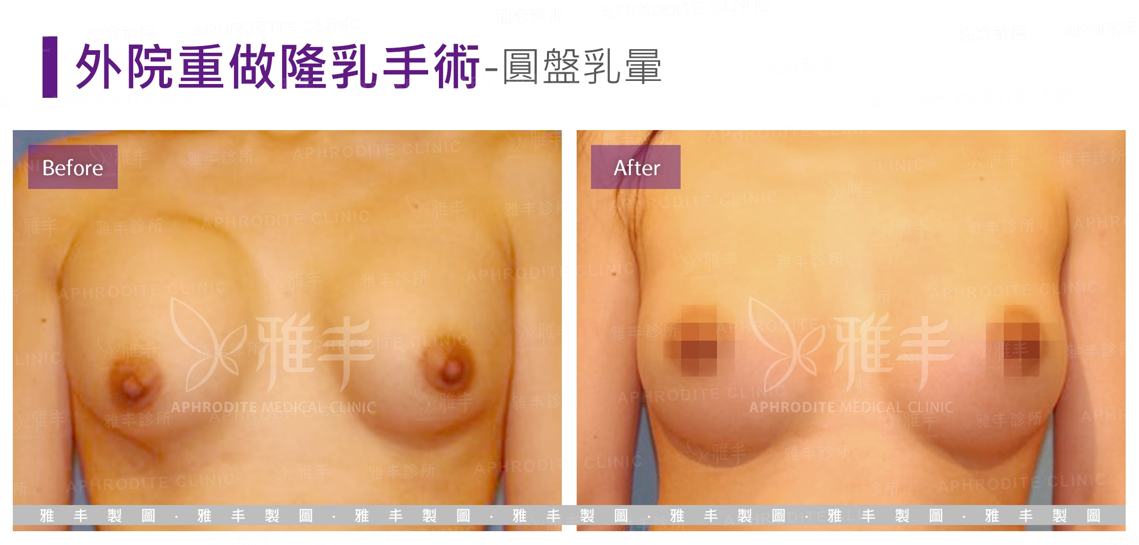 外院重做隆乳手術-圓盤乳暈(Case5)