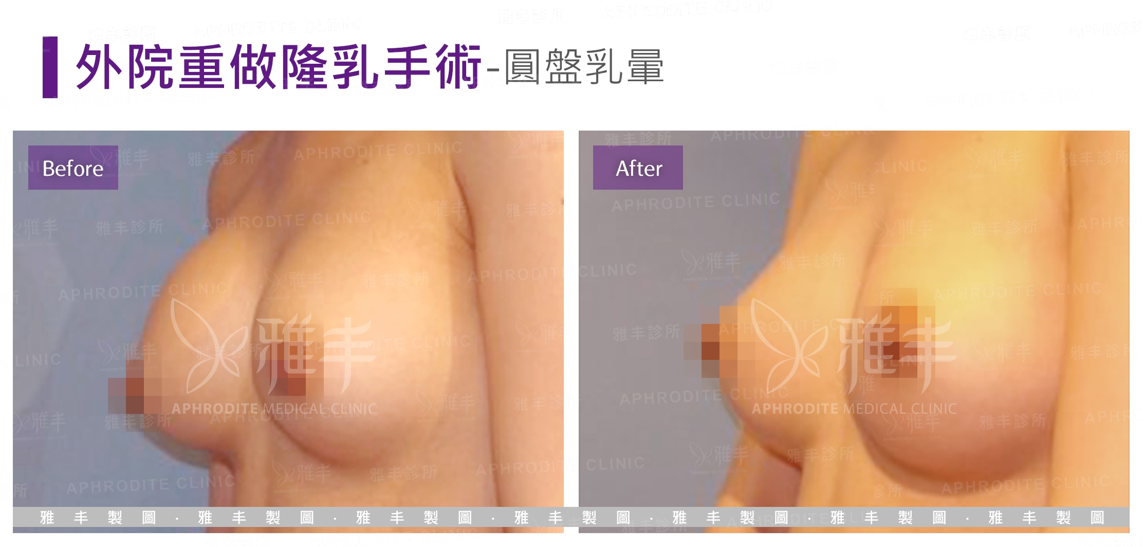 外院重做隆乳手術-圓盤乳暈(Case5-L45)