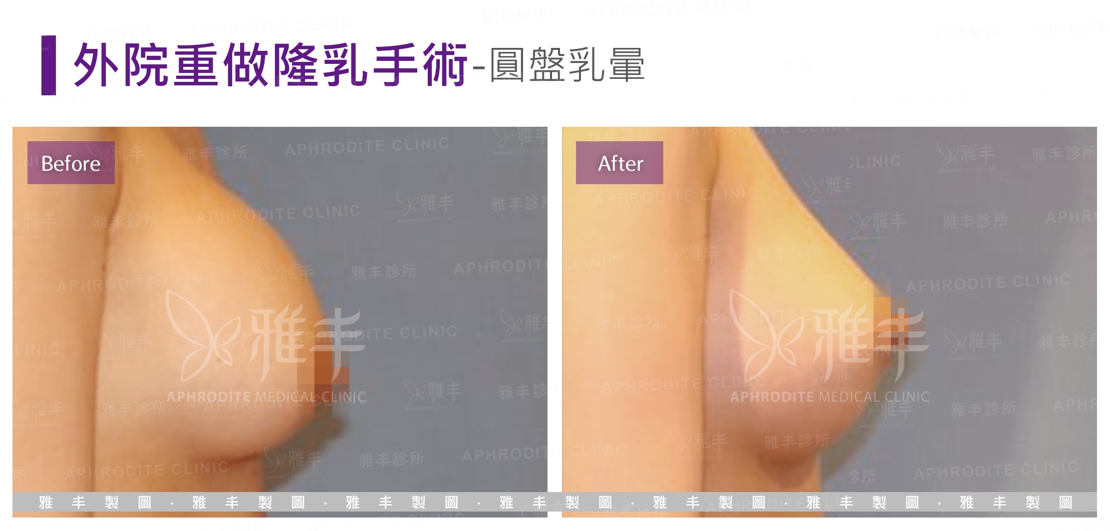 外院重做隆乳手術-圓盤乳暈(Case5-R90)