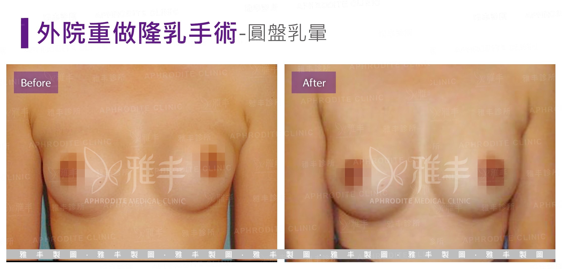 外院重做隆乳手術-圓盤乳暈(Case6)