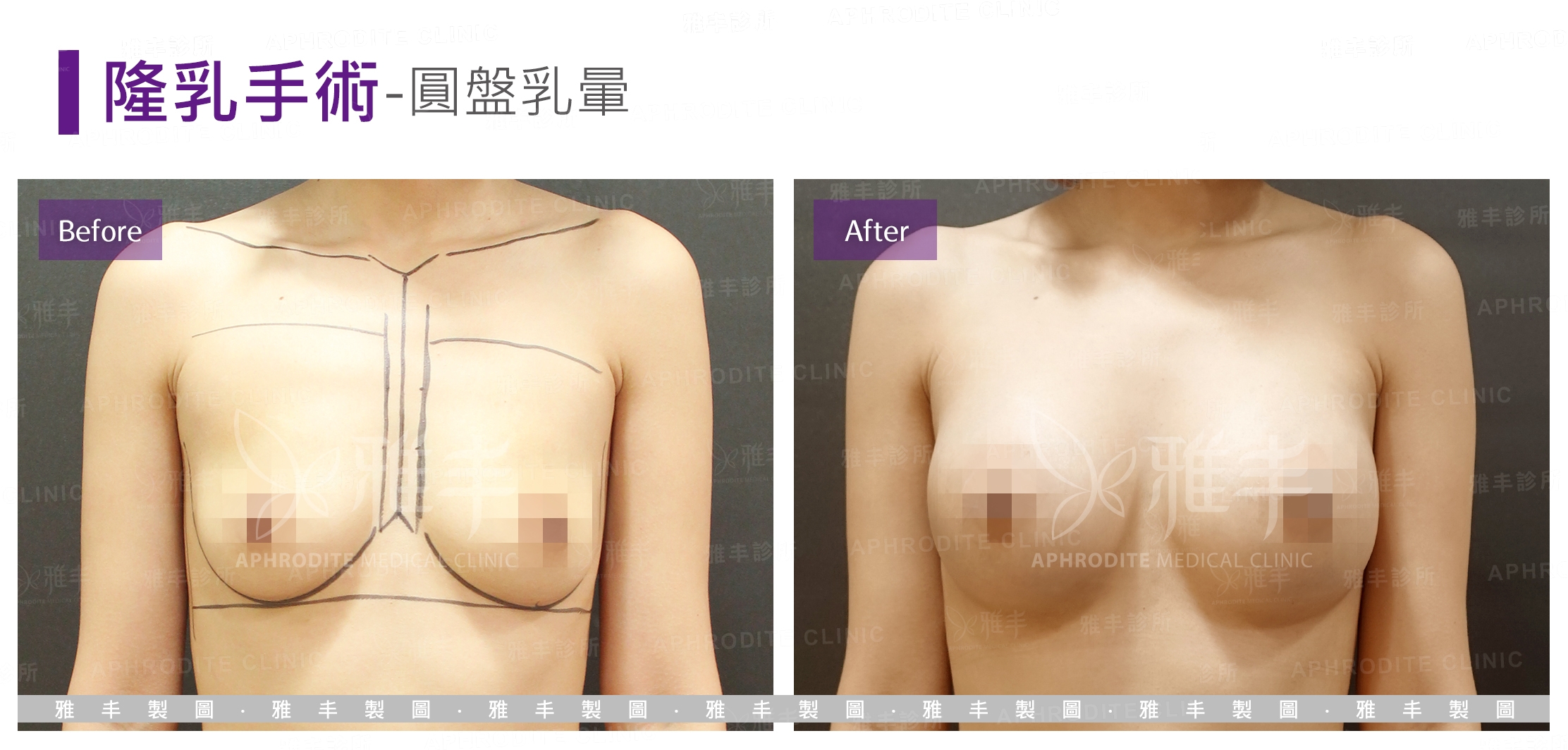 隆乳手術-圓盤乳暈(Case7)