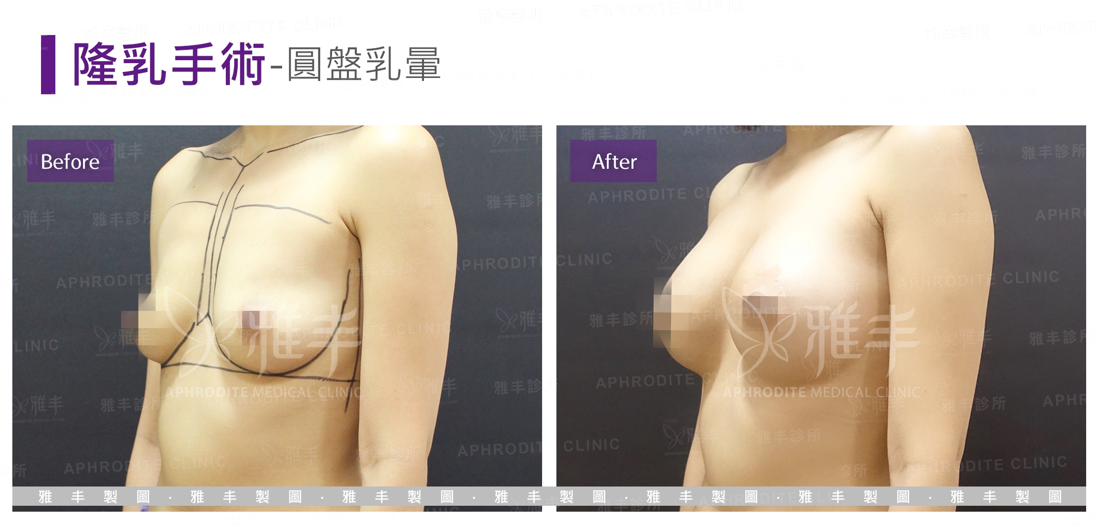 隆乳手術-圓盤乳暈(Case7-L45)