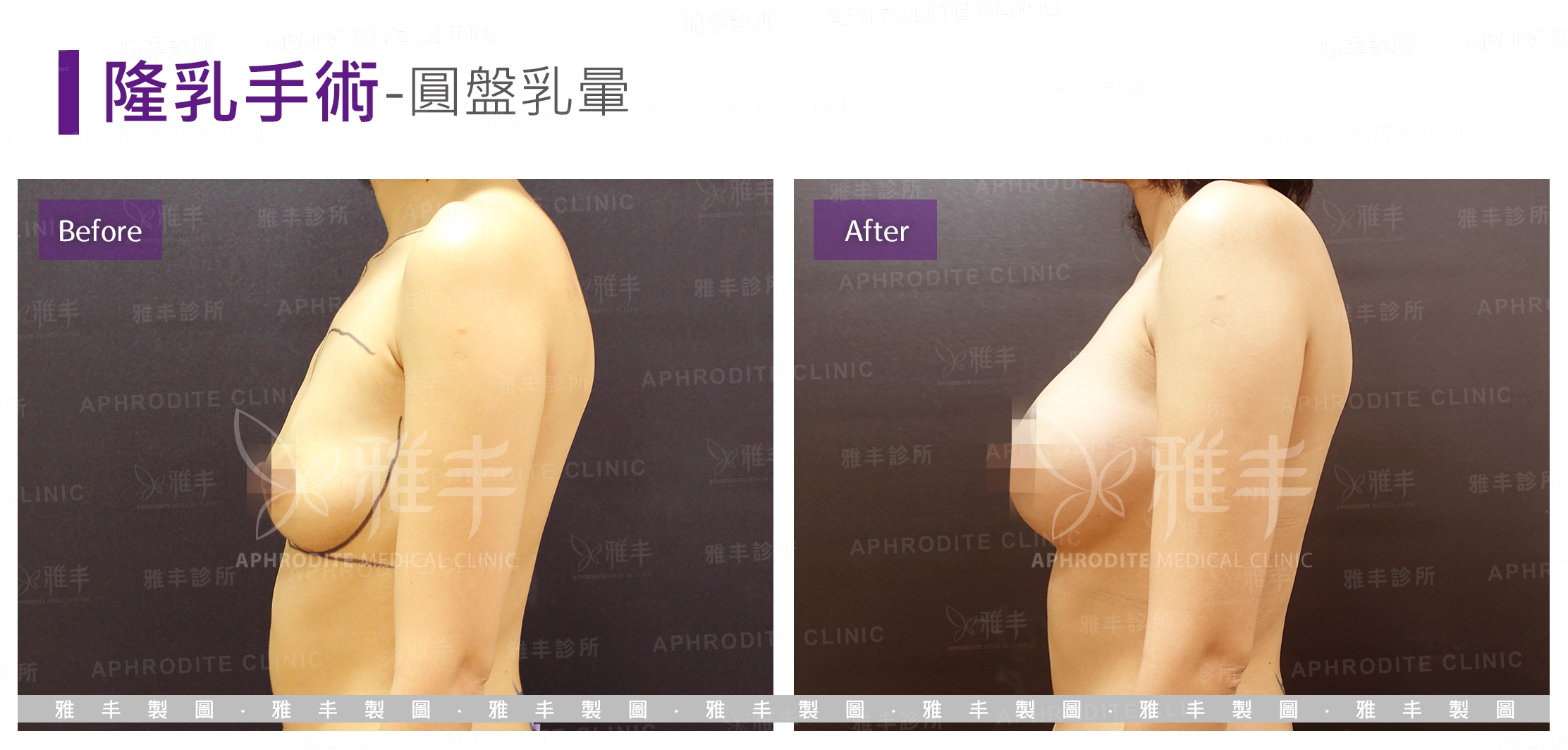 隆乳手術-圓盤乳暈(Case7-L90)