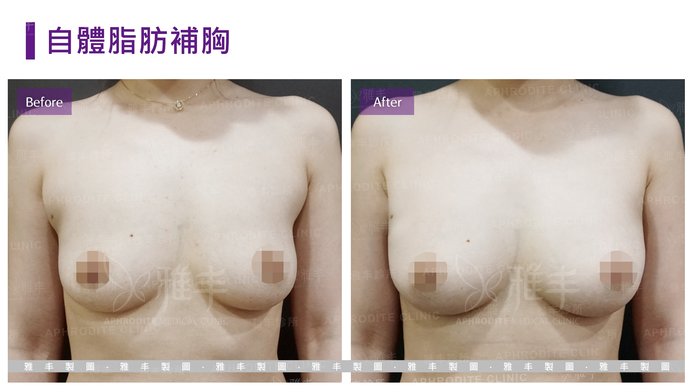 自體脂肪補胸(Case1)