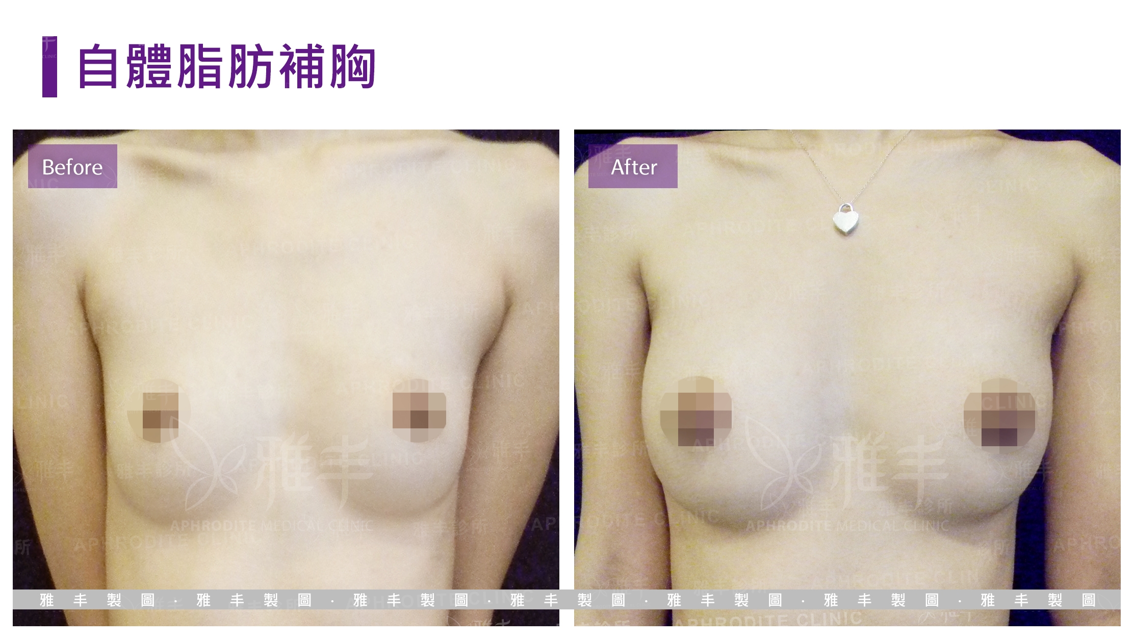 自體脂肪補胸(Case3)