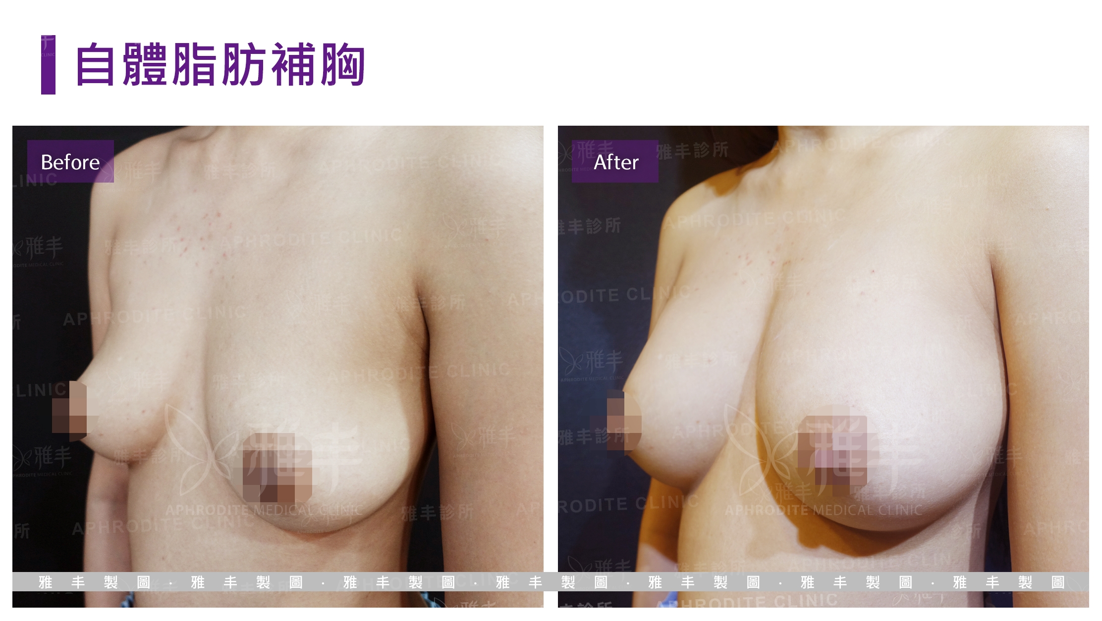 自體脂肪補胸(Case4-L45)