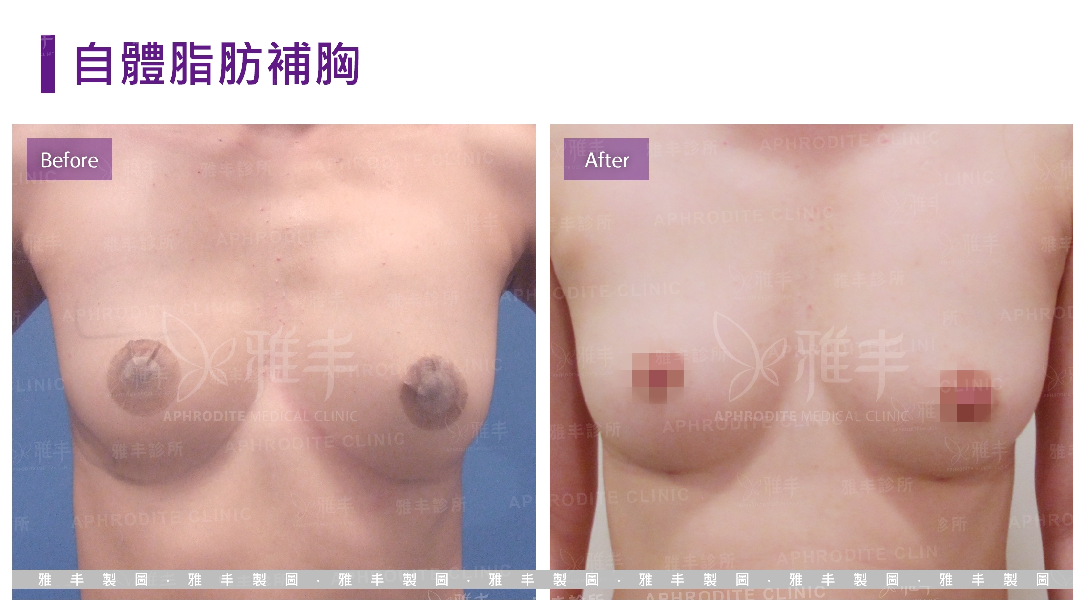 自體脂肪補胸(Case5)