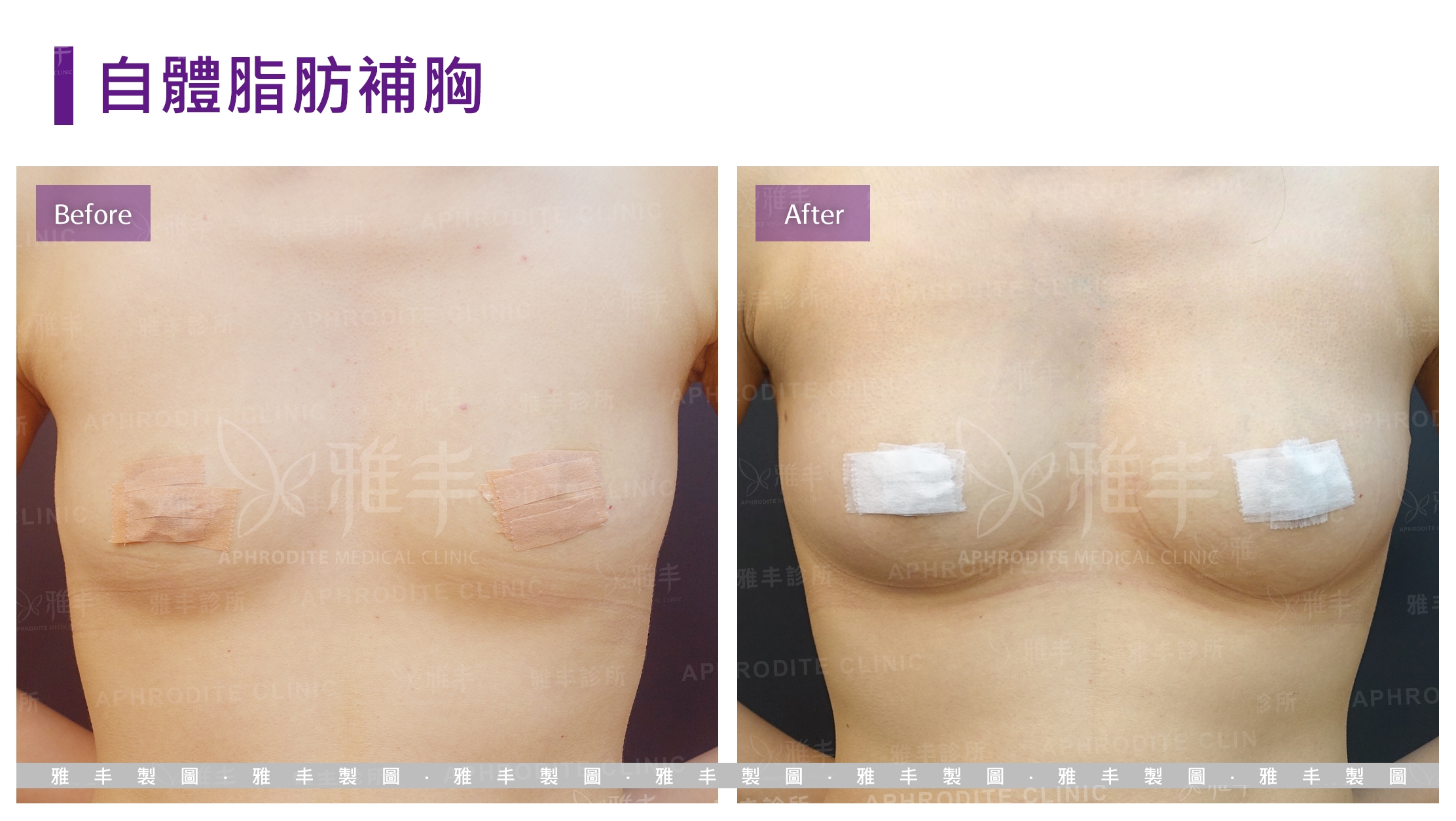 自體脂肪補胸(Case6)