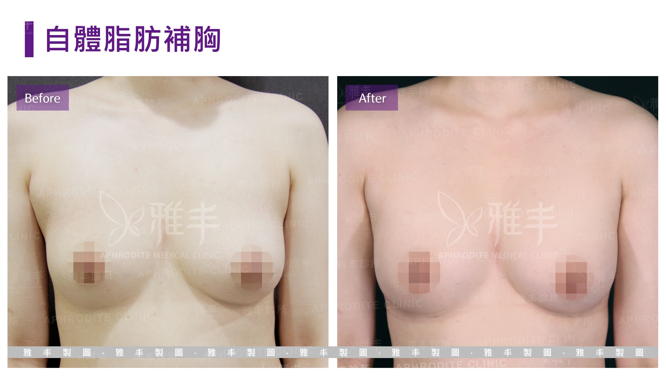 自體脂肪補胸(Case7)