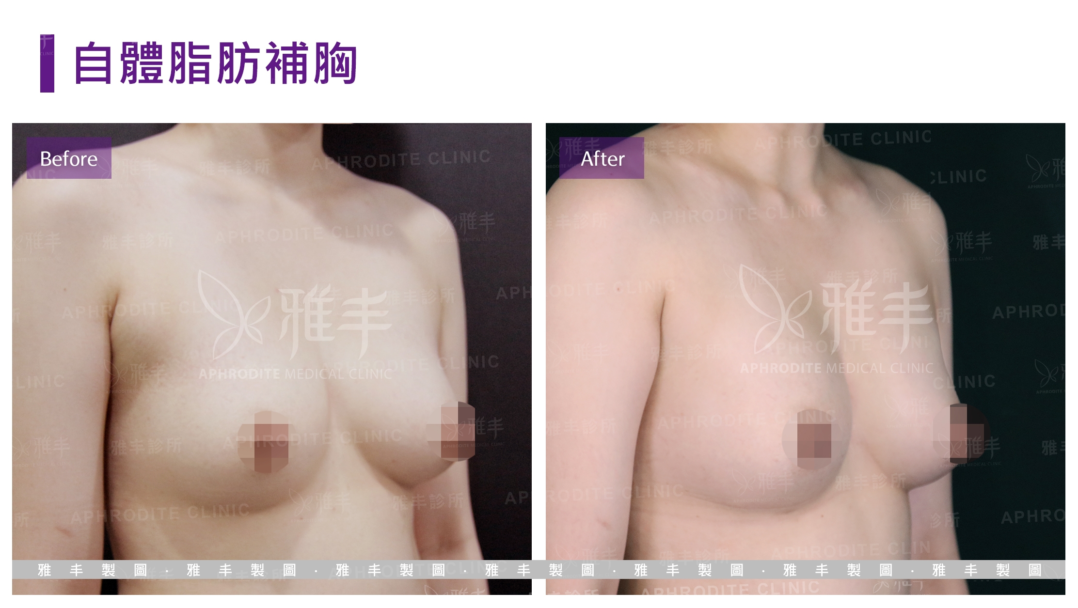 自體脂肪補胸(Case7-R45)