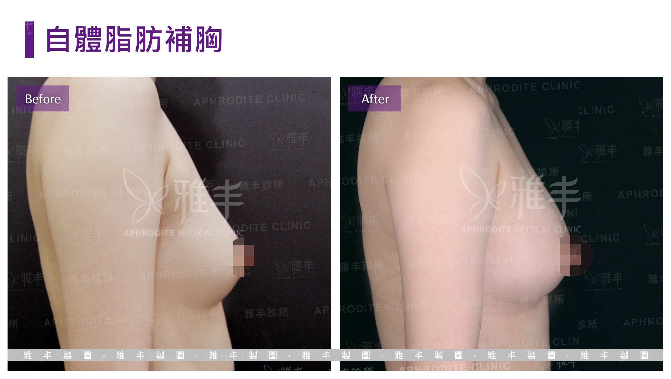 自體脂肪補胸(Case7-R90)