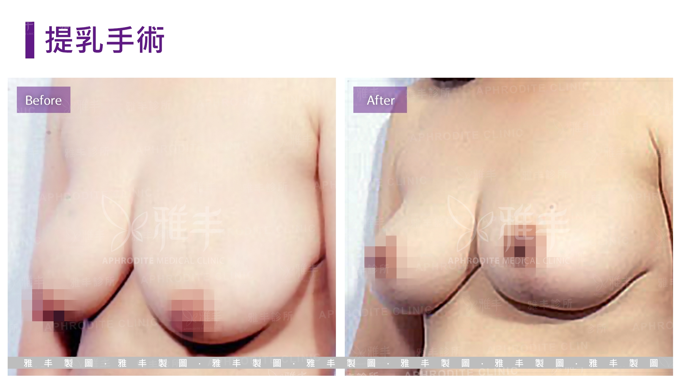 提乳手術(Case1-L45)