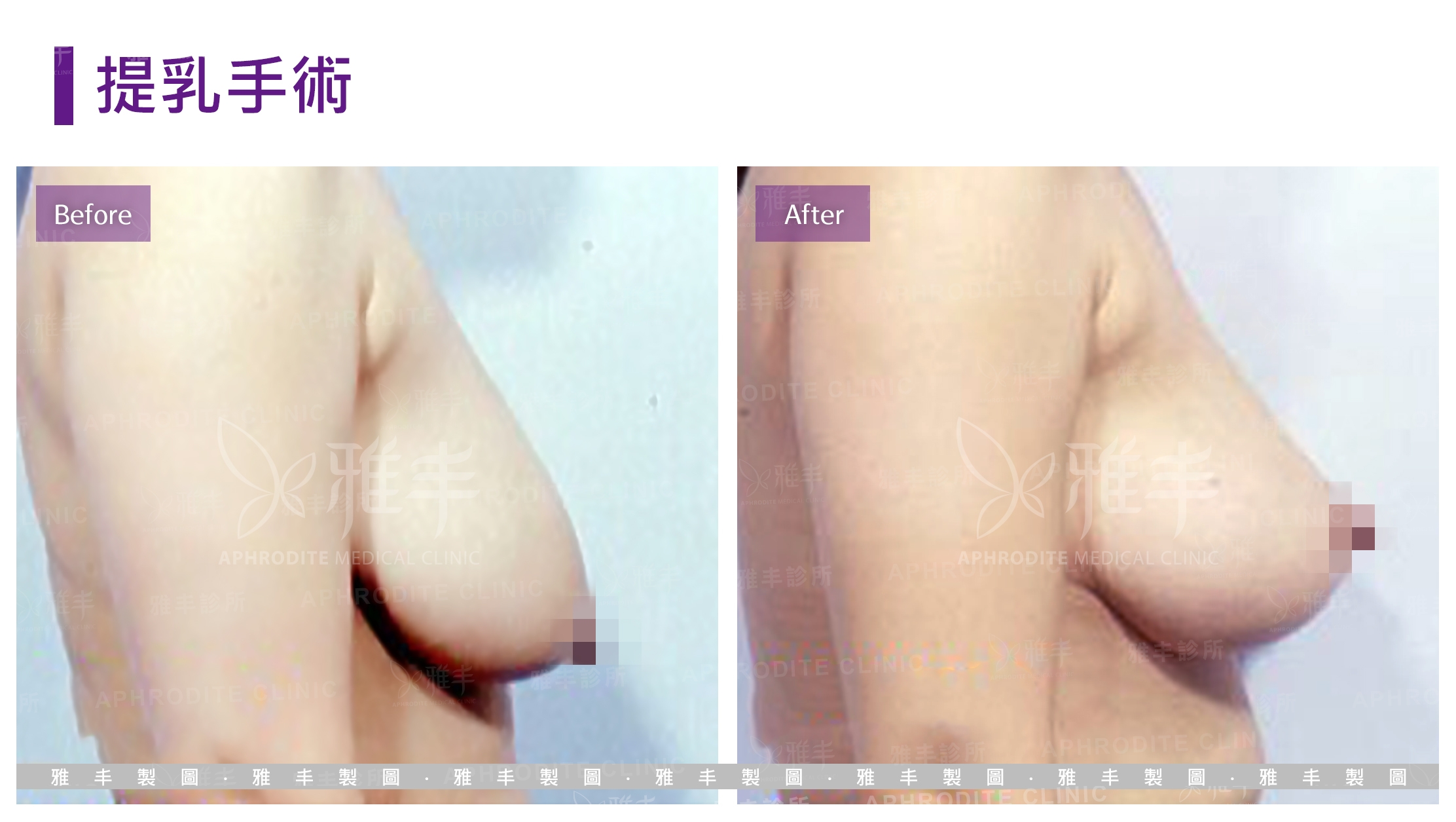 提乳手術(Case1-R90)