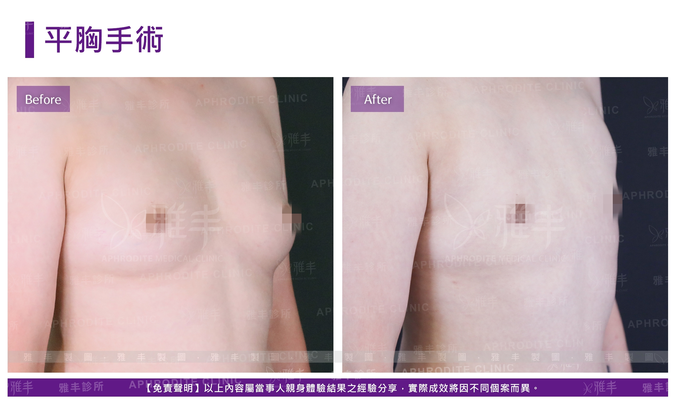 平胸手術(Case1-R45)