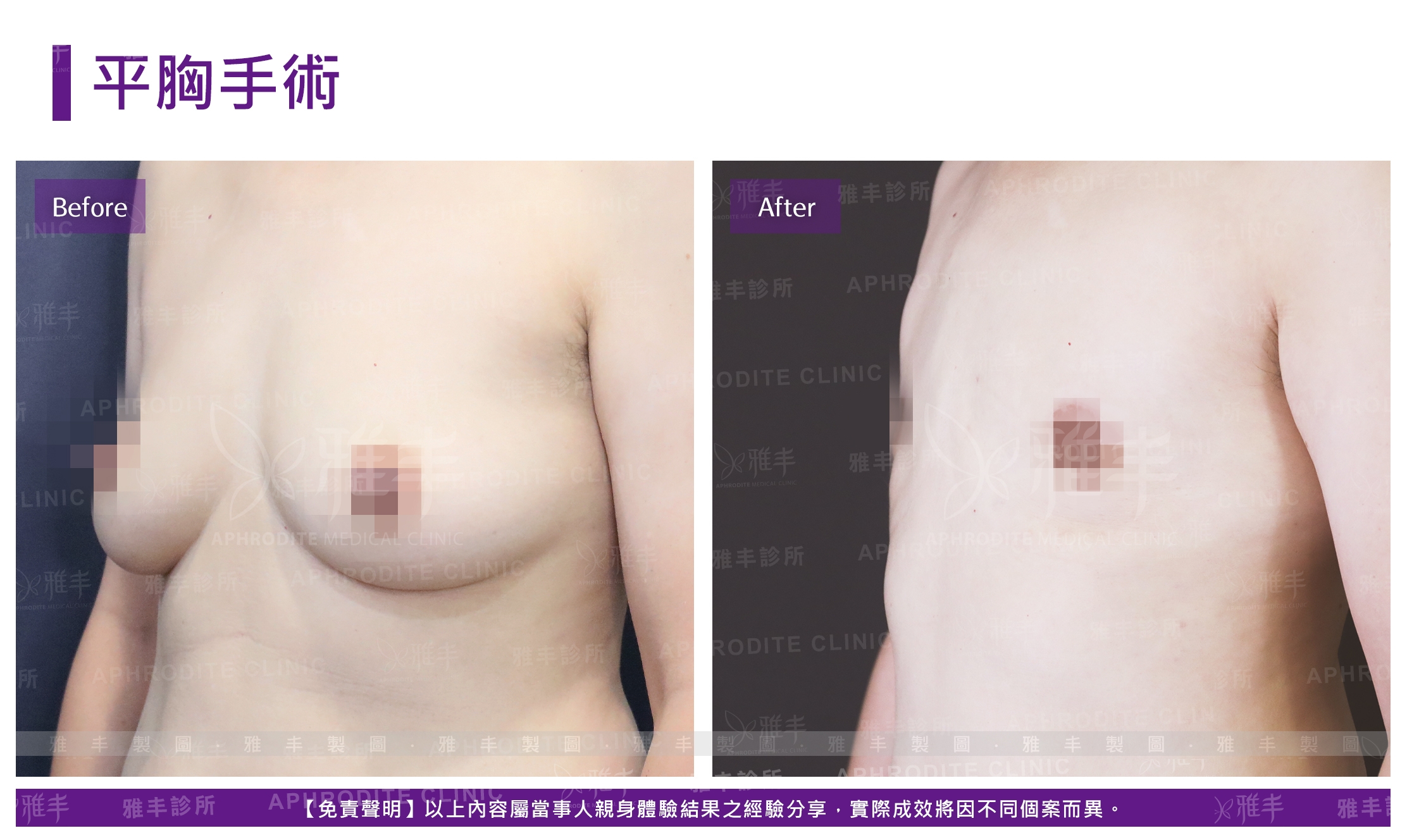 平胸手術(Case2-L45)