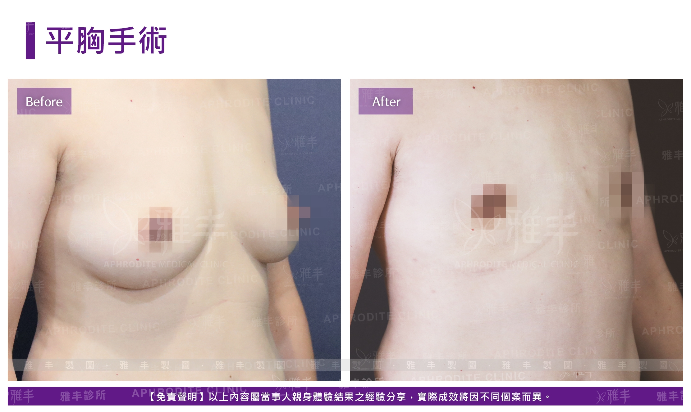 平胸手術(Case2-R45)