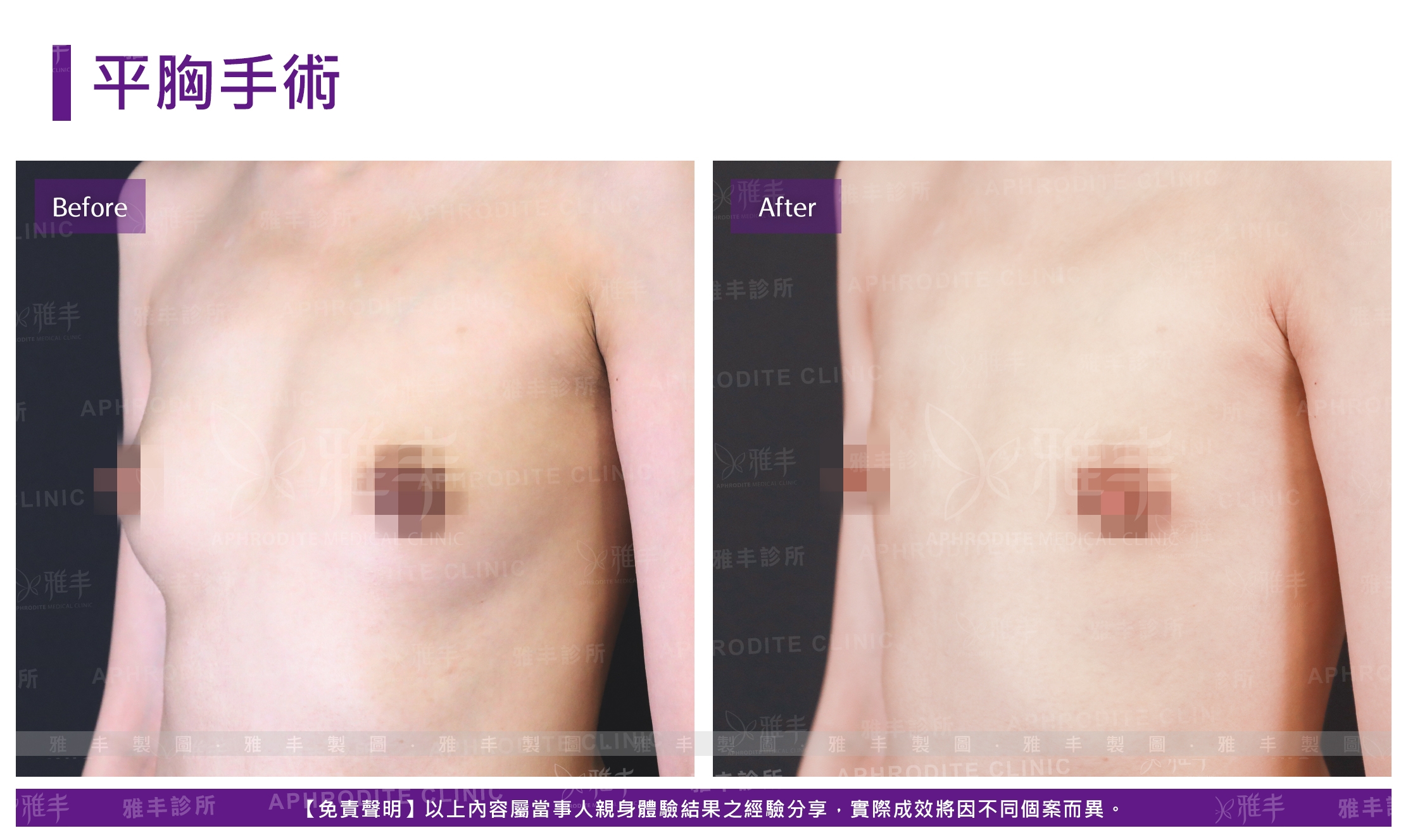 平胸手術(Case3-L45)
