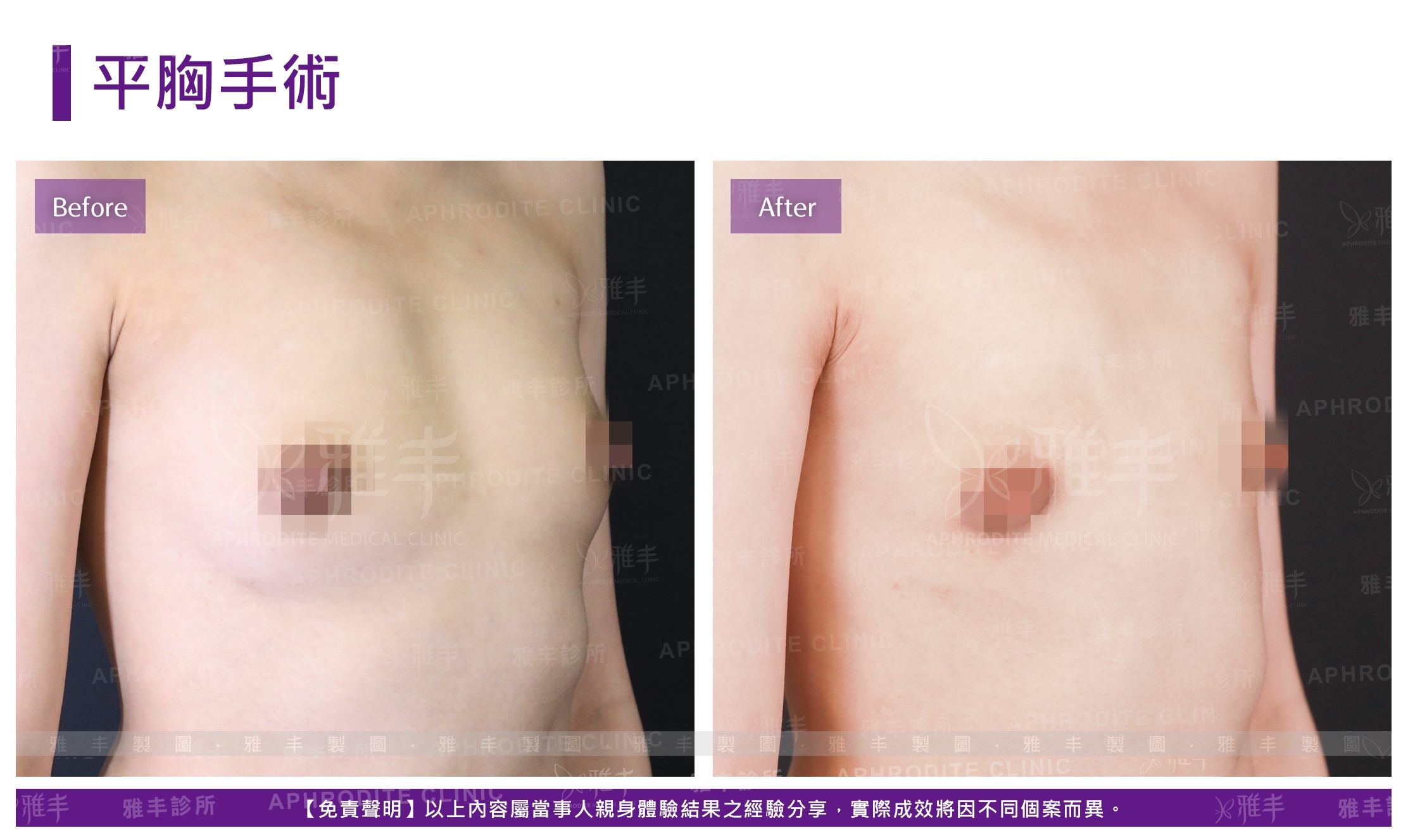 平胸手術(Case3-R45)