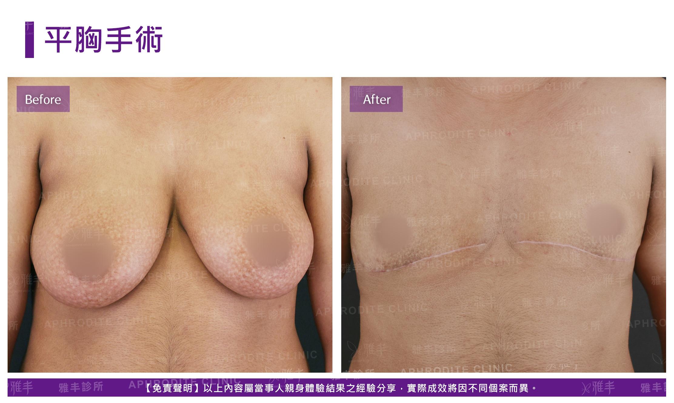 平胸手術-case4-F.jpg