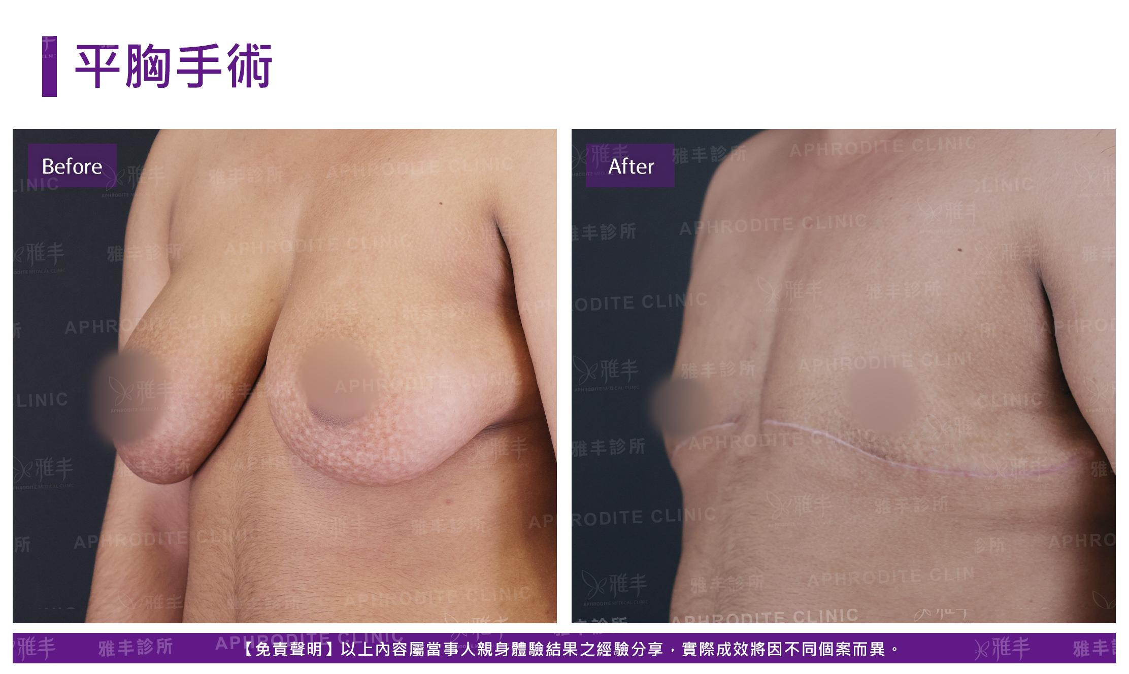 平胸手術-case4-L45.jpg