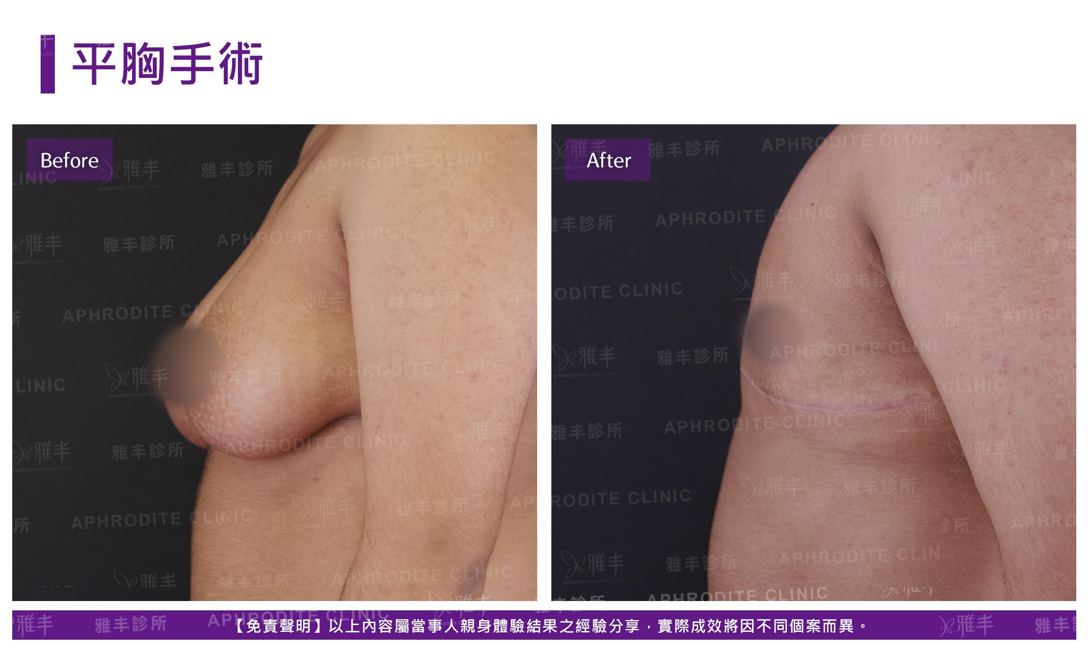 平胸手術-case4-L90.jpg