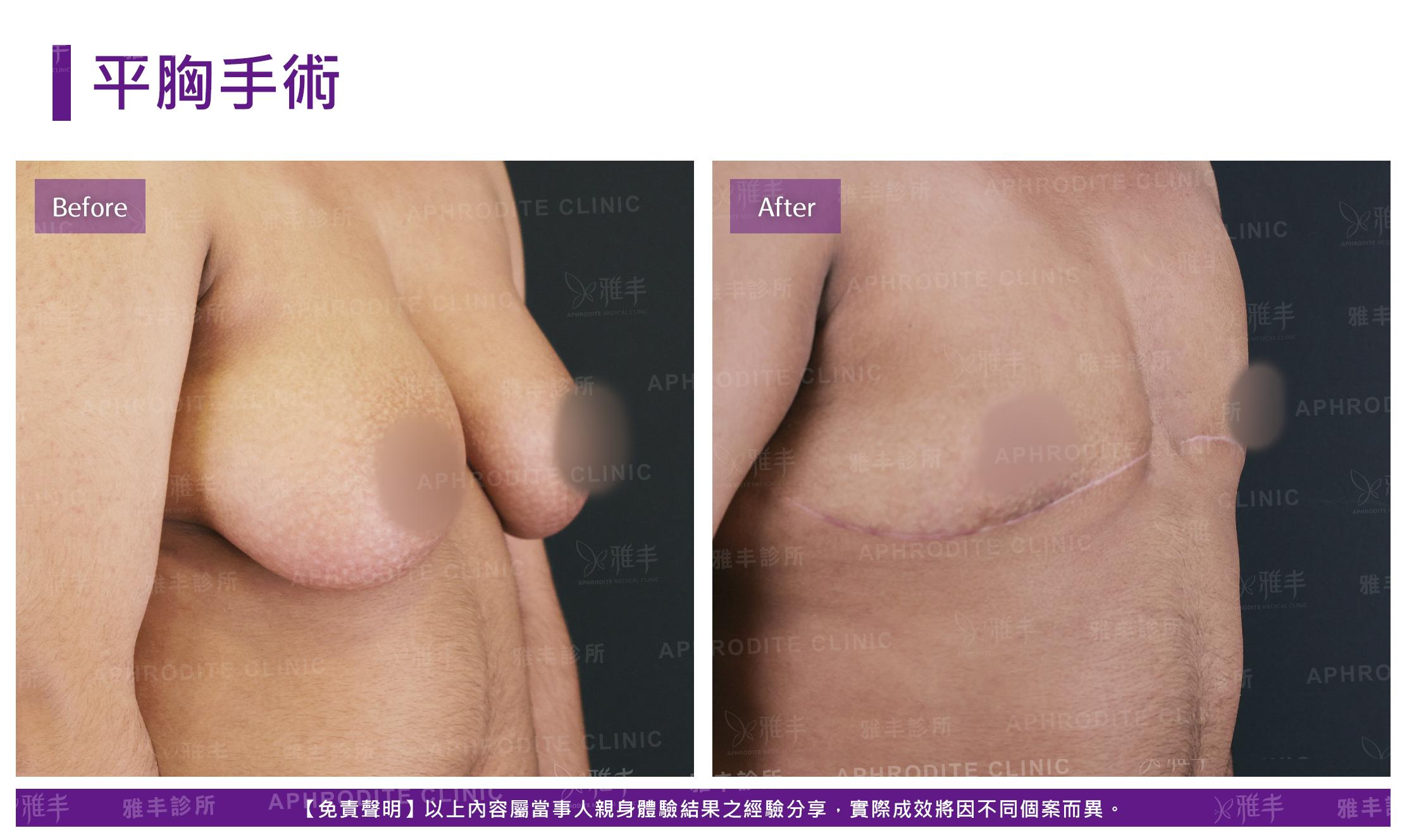 平胸手術-case4-R45.jpg