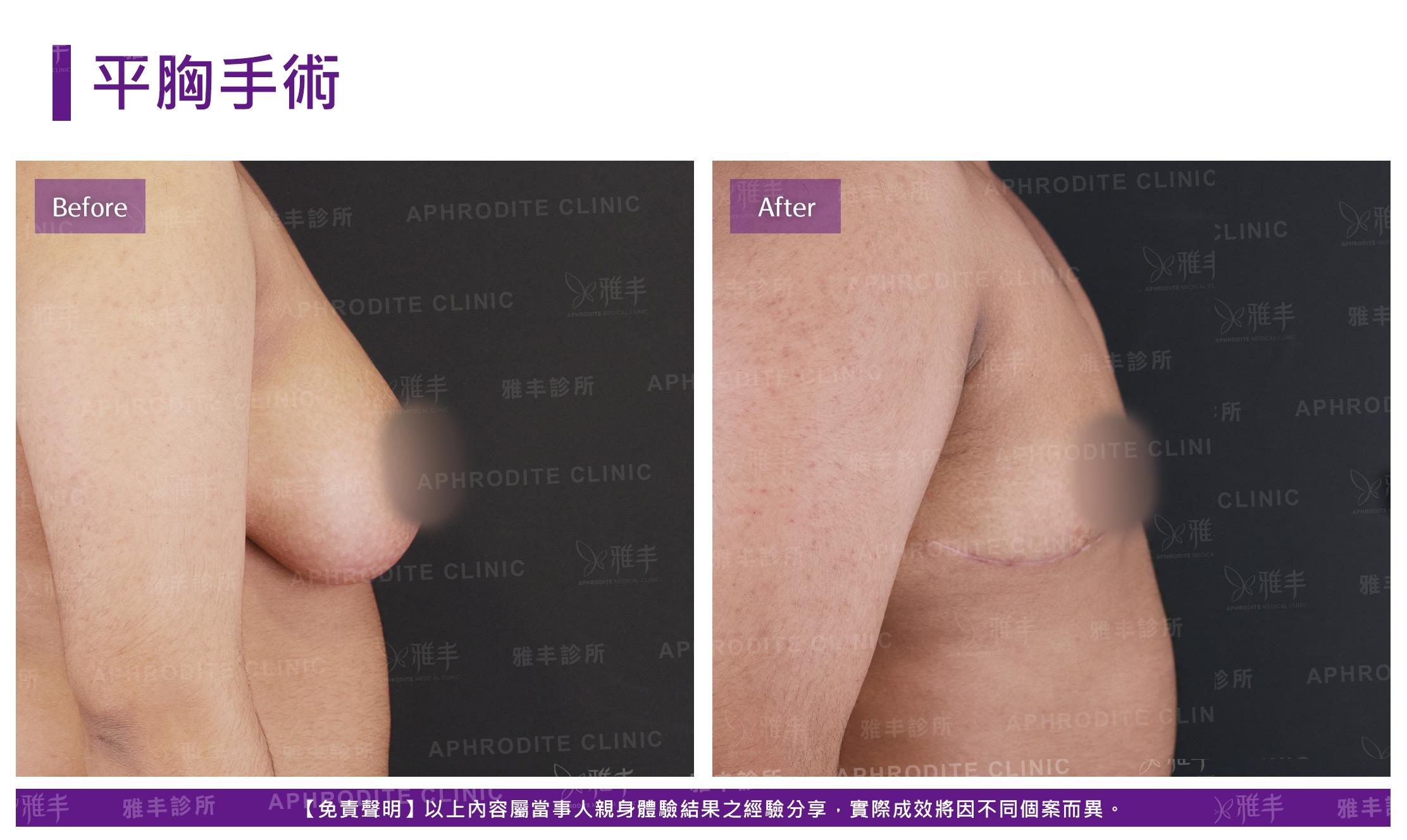 平胸手術-case4-R90.jpg