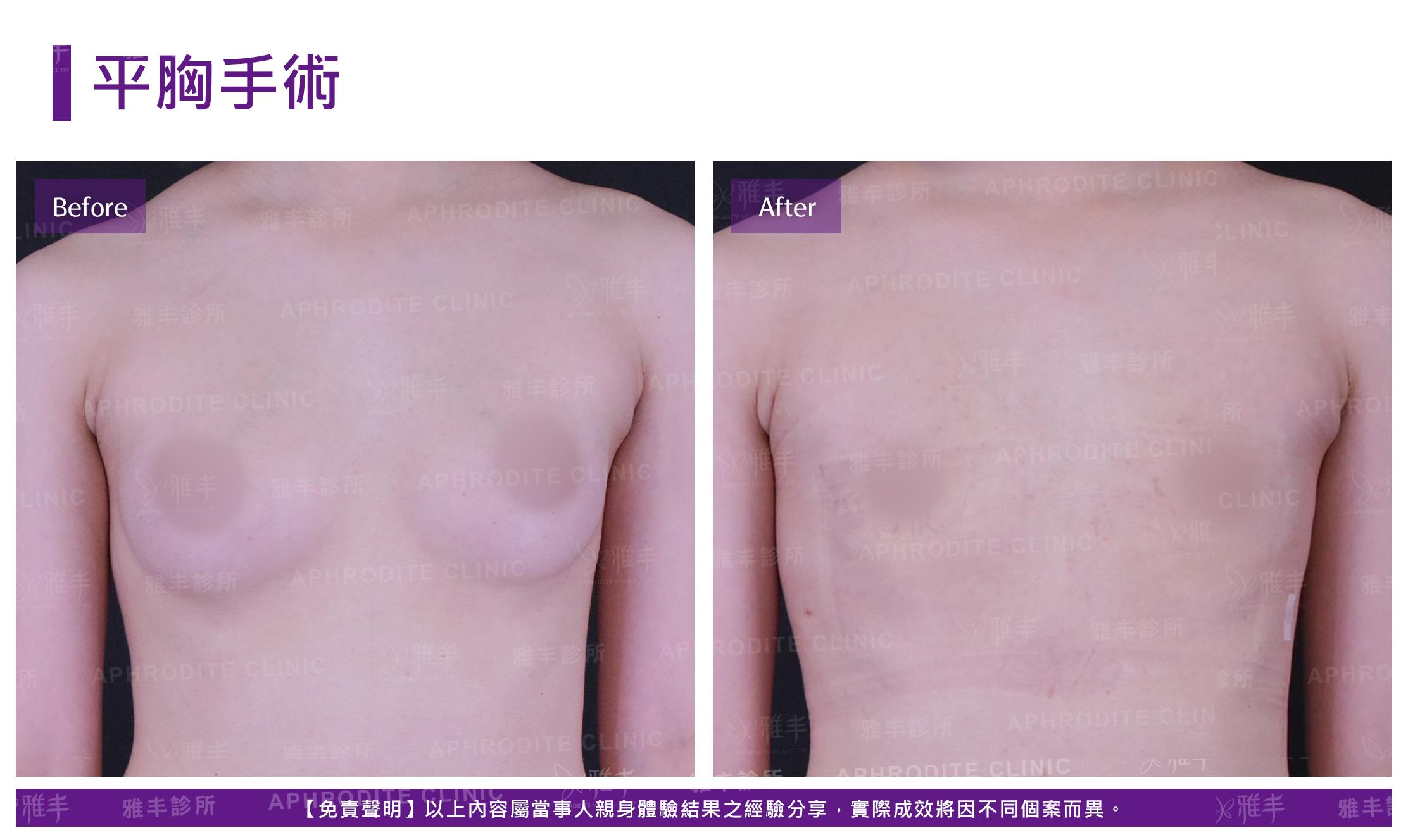 平胸手術-case5-F.jpg
