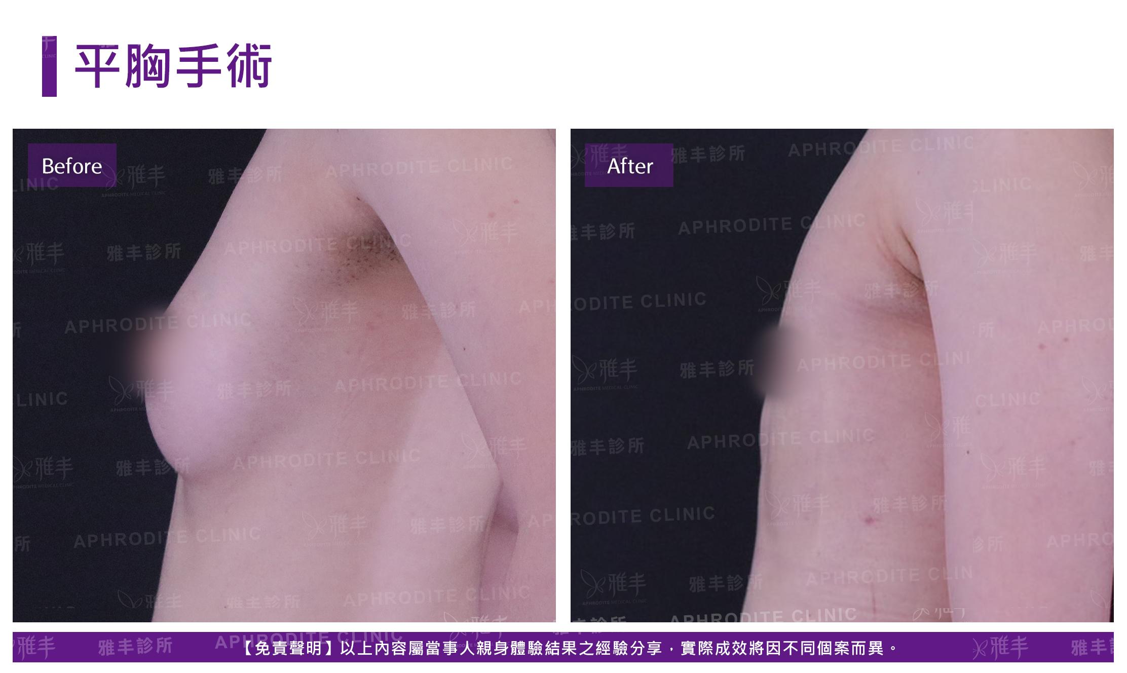 平胸手術-case5-L90.jpg