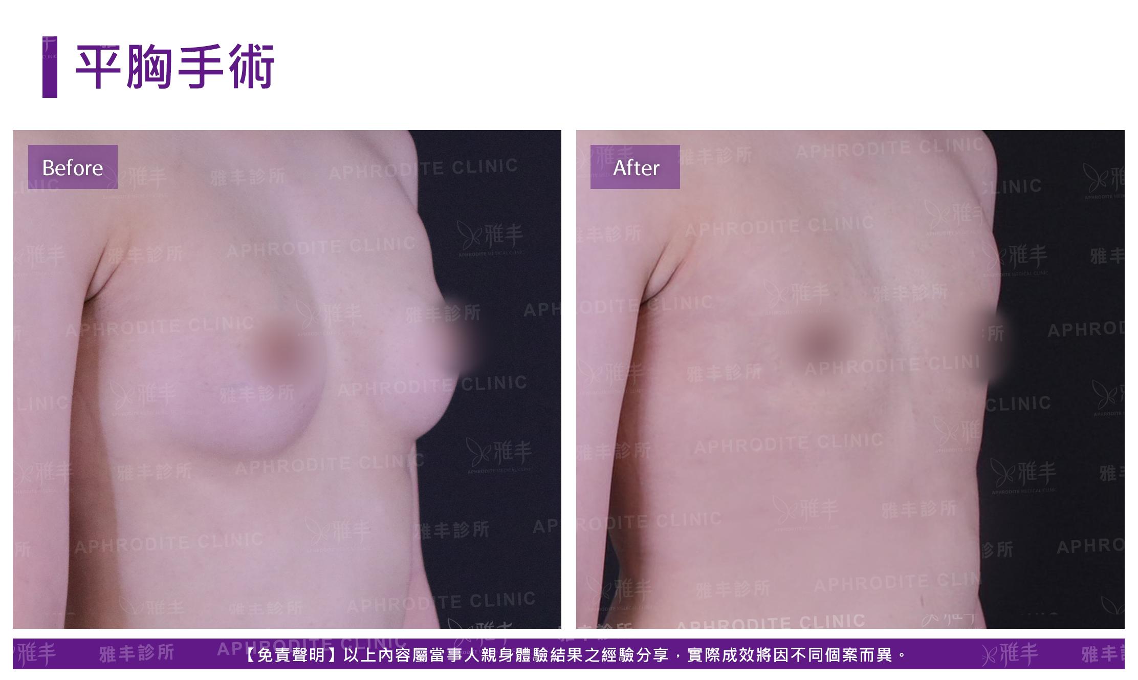 平胸手術-case5-R45.jpg