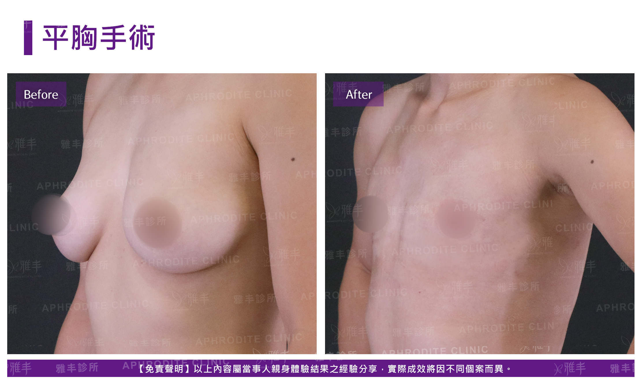 平胸手術-5-case6-L45