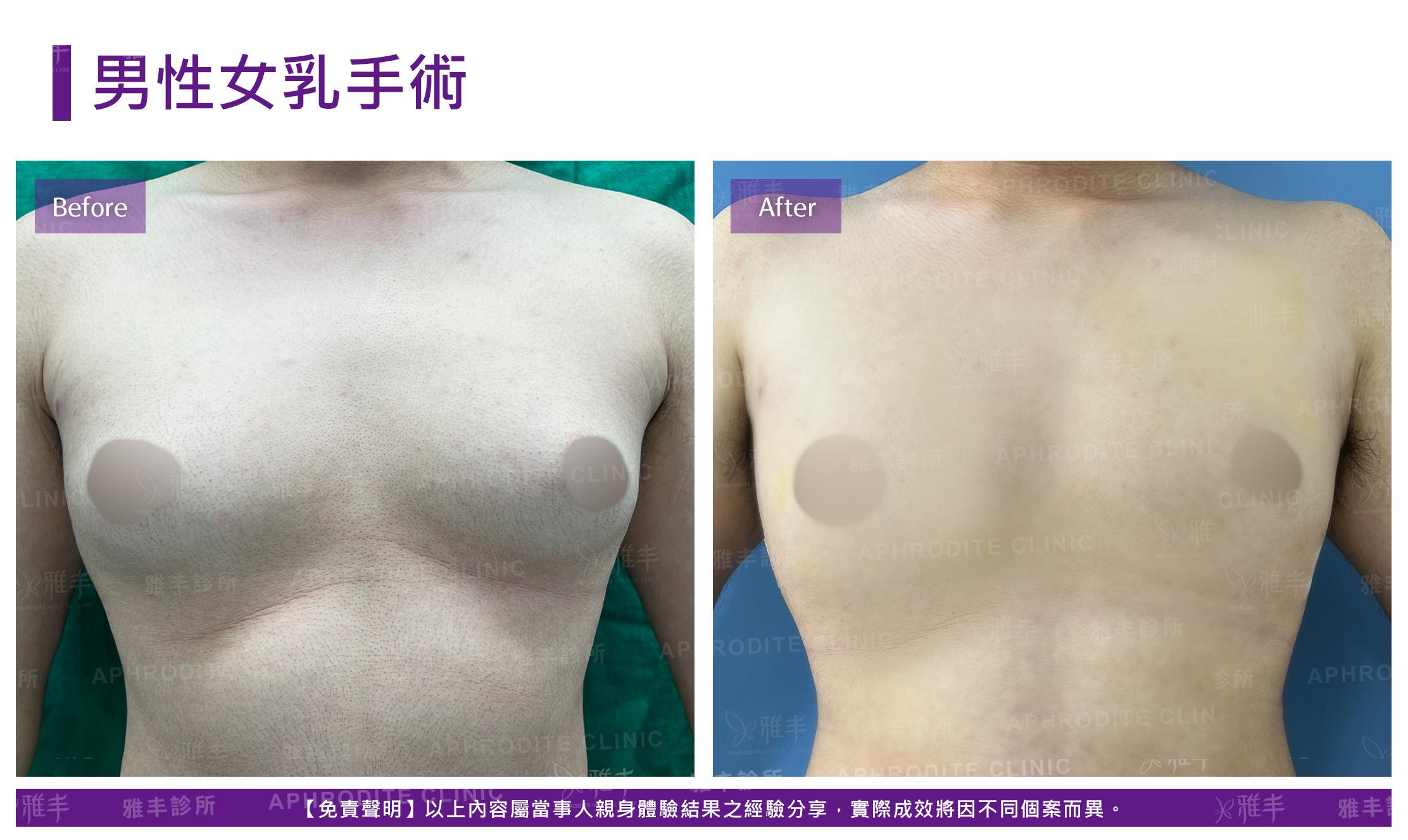 男性女乳手術-case8-F.jpg