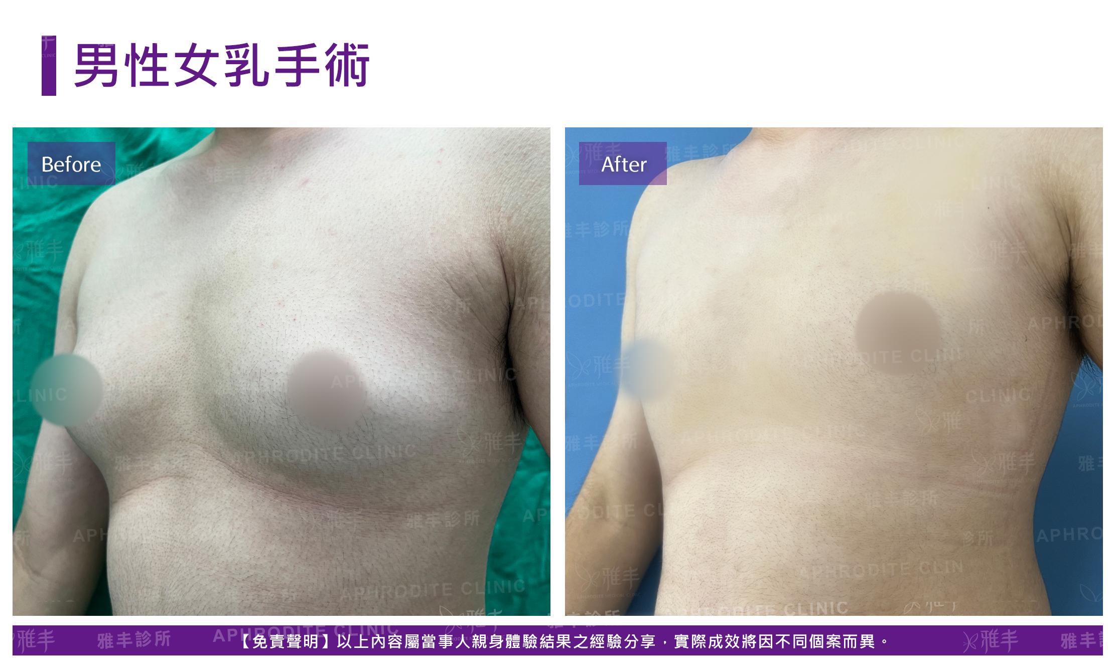男性女乳手術-case8-L45.jpg