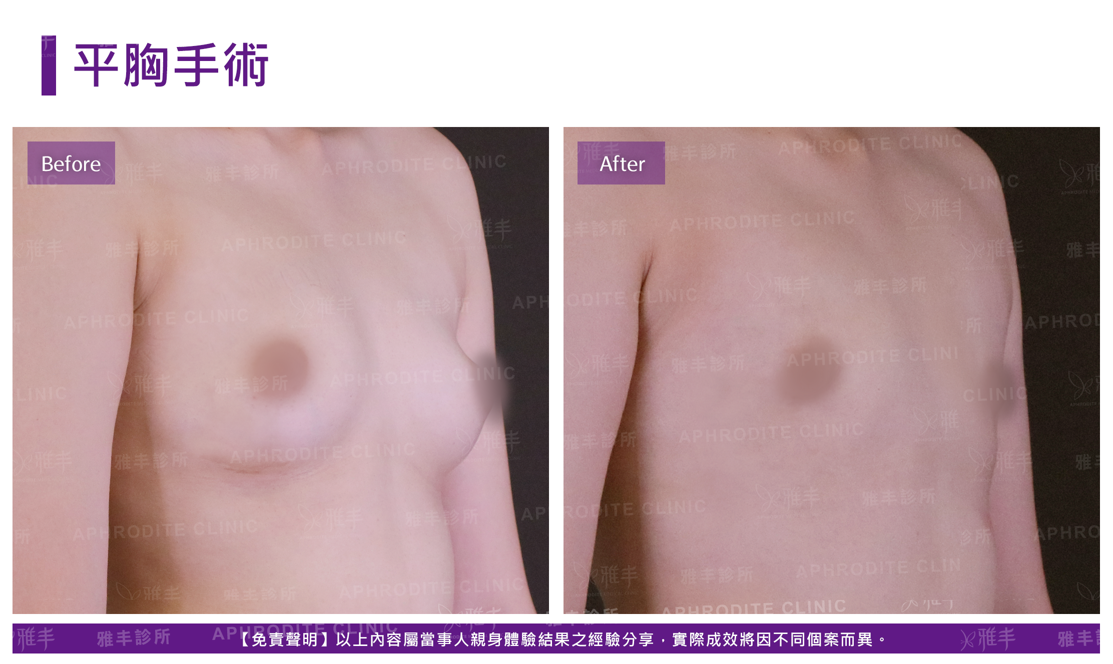 平胸手術-5-case8-L45