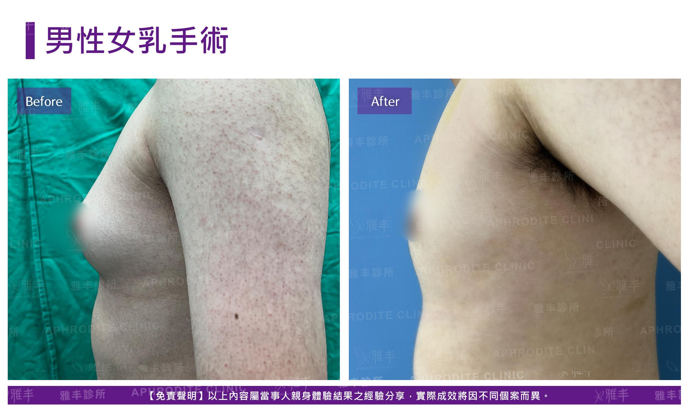 男性女乳手術-case8-L90.jpg