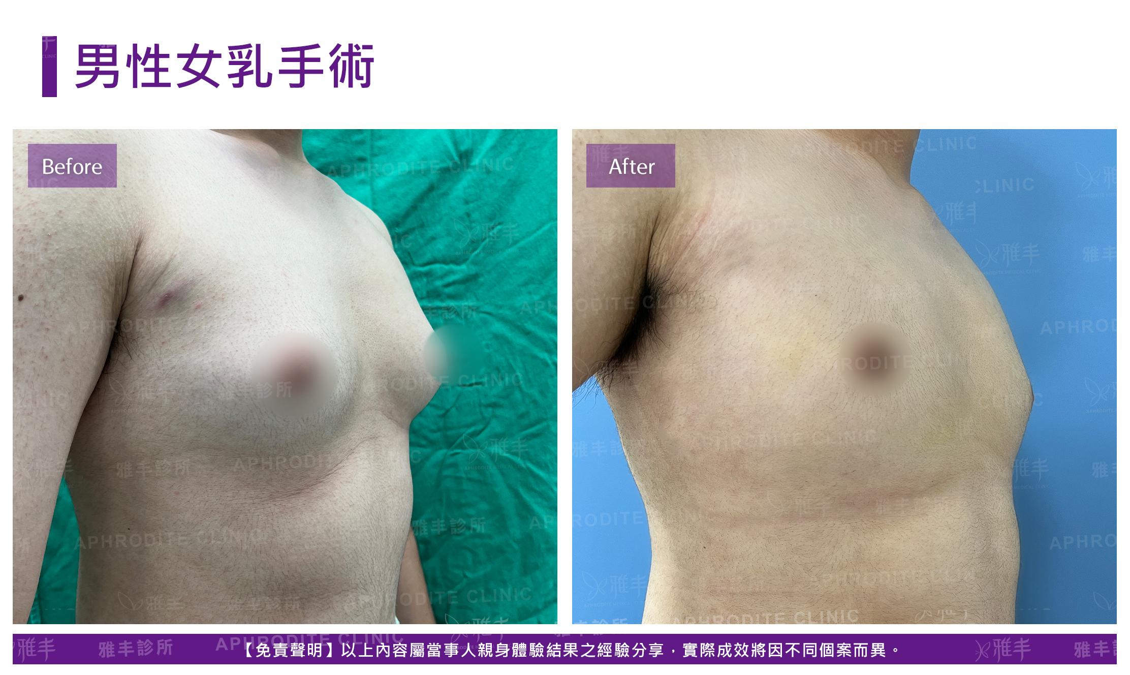 男性女乳手術-case8-R45.jpg