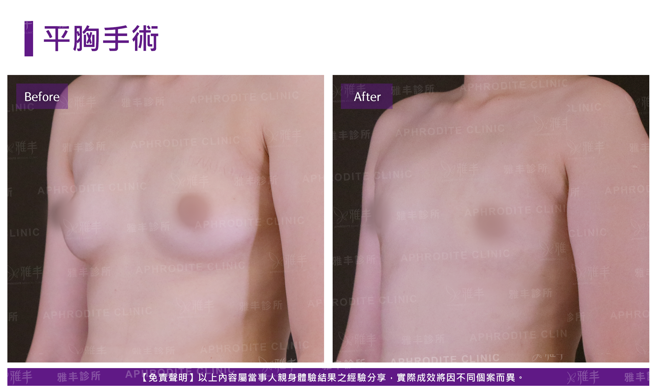 平胸手術-5-case8-R45