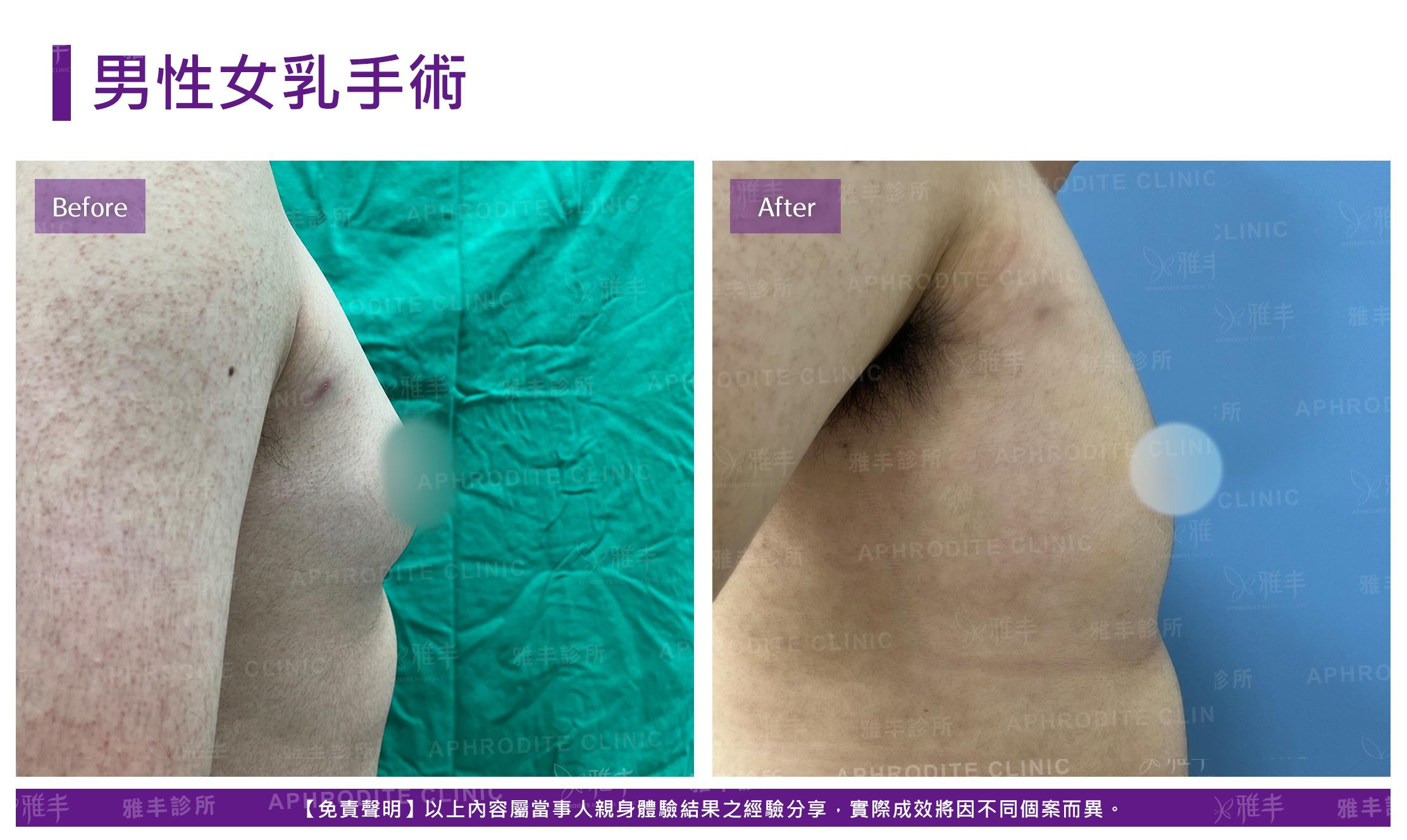 男性女乳手術-case8-R90.jpg