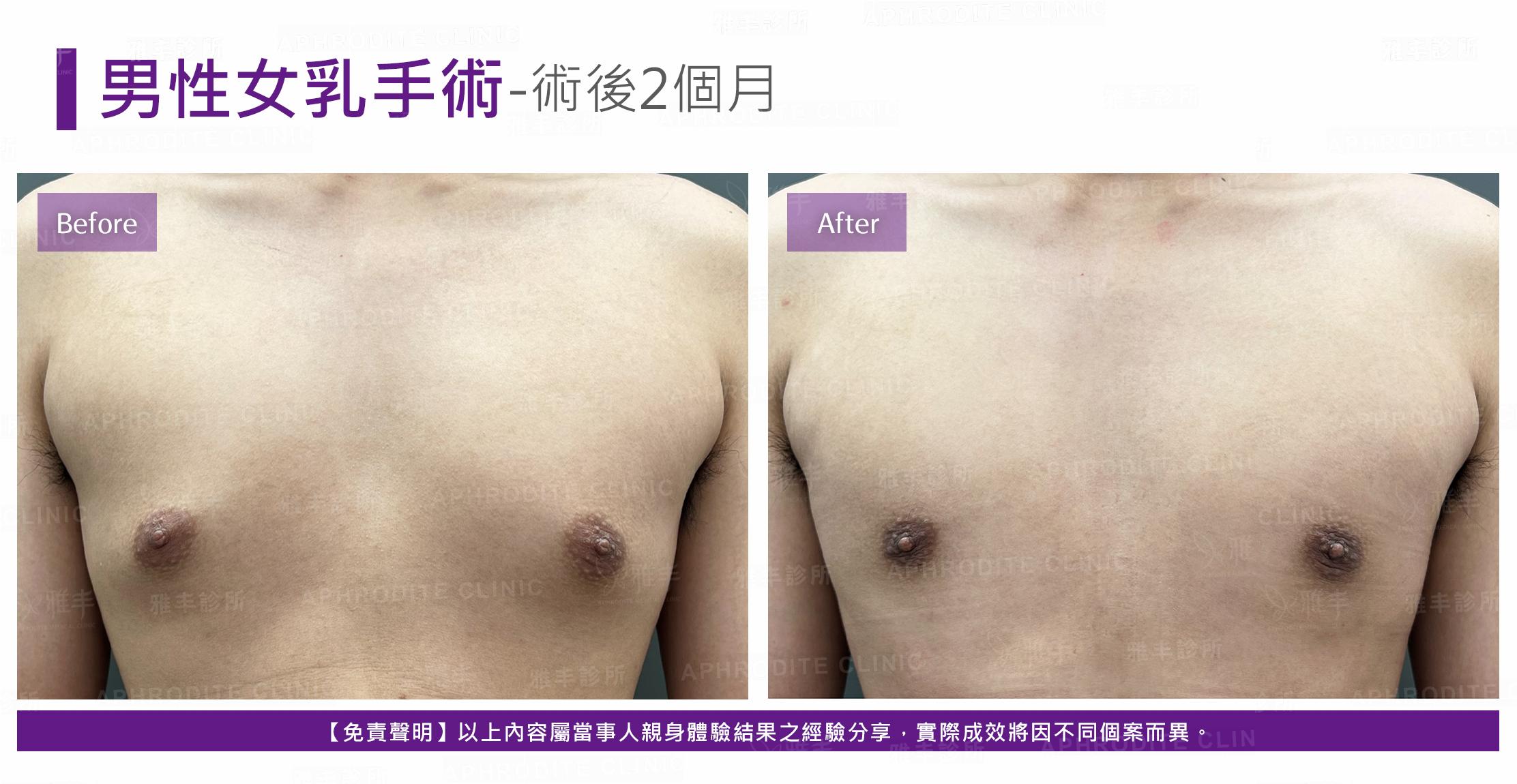 男性平胸-case9-F.jpg