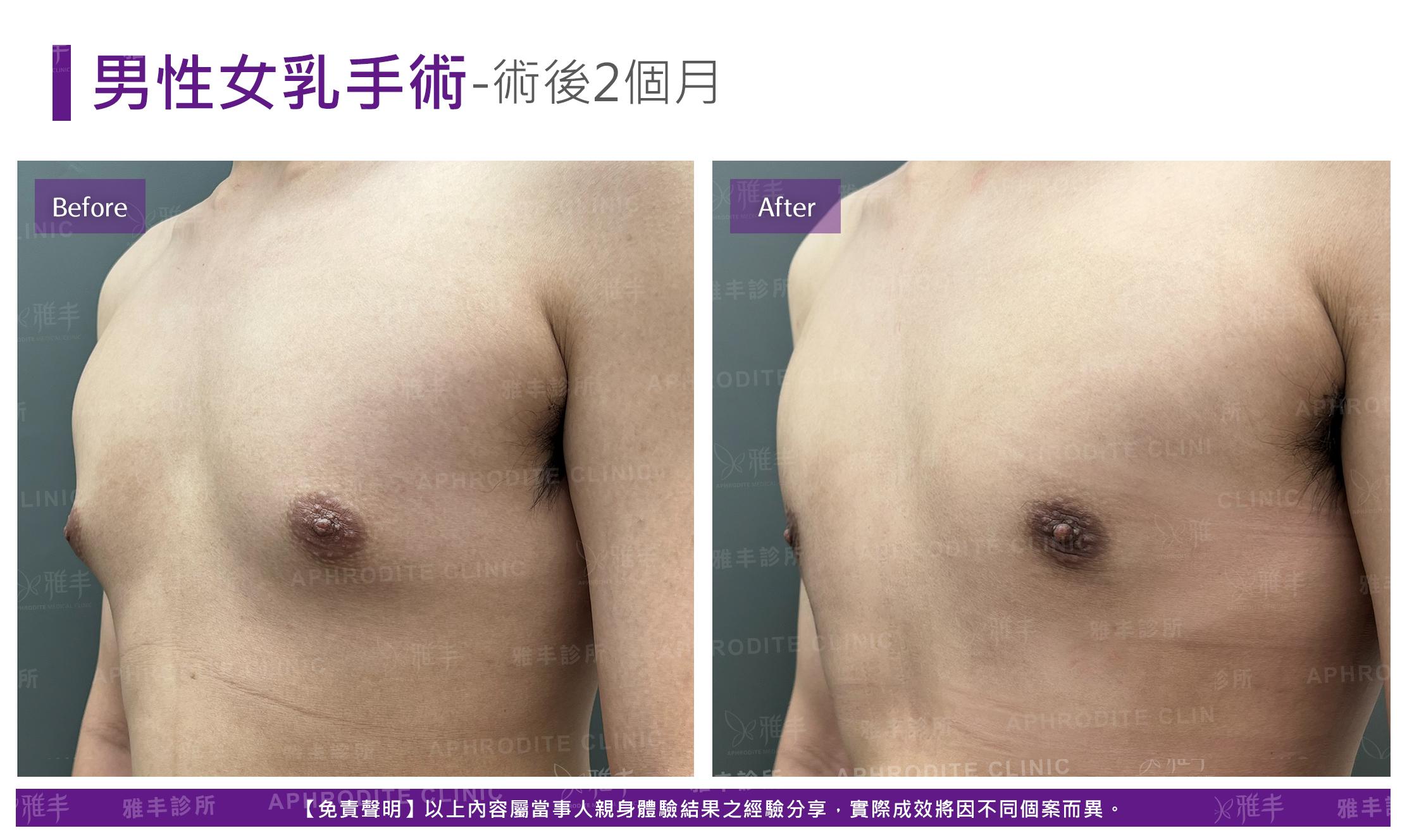 男性平胸-case9-L45
